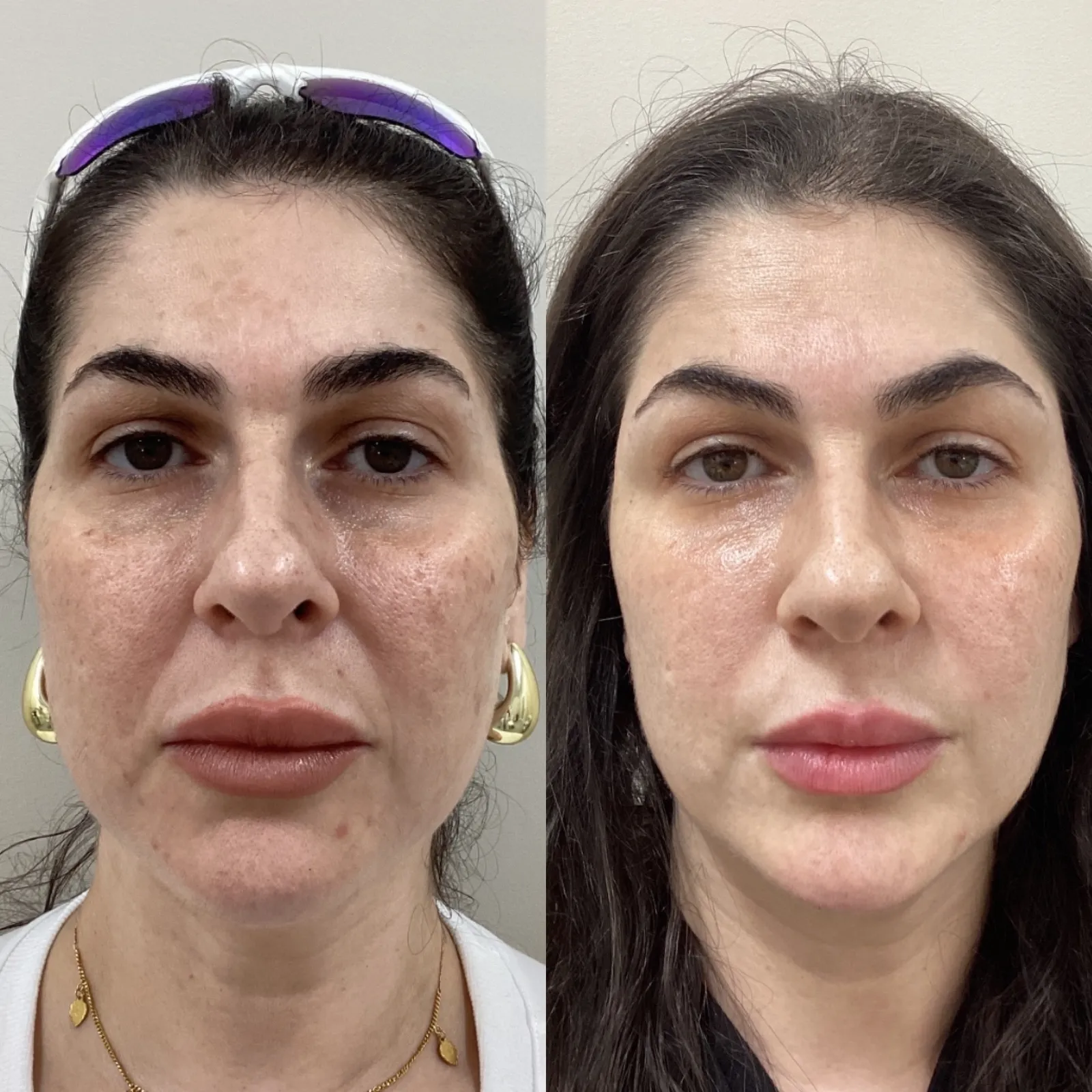 Radiesse for facial structure, front view of the mid-face, before and after, at La Miel Aesthetics in Raleigh, NC