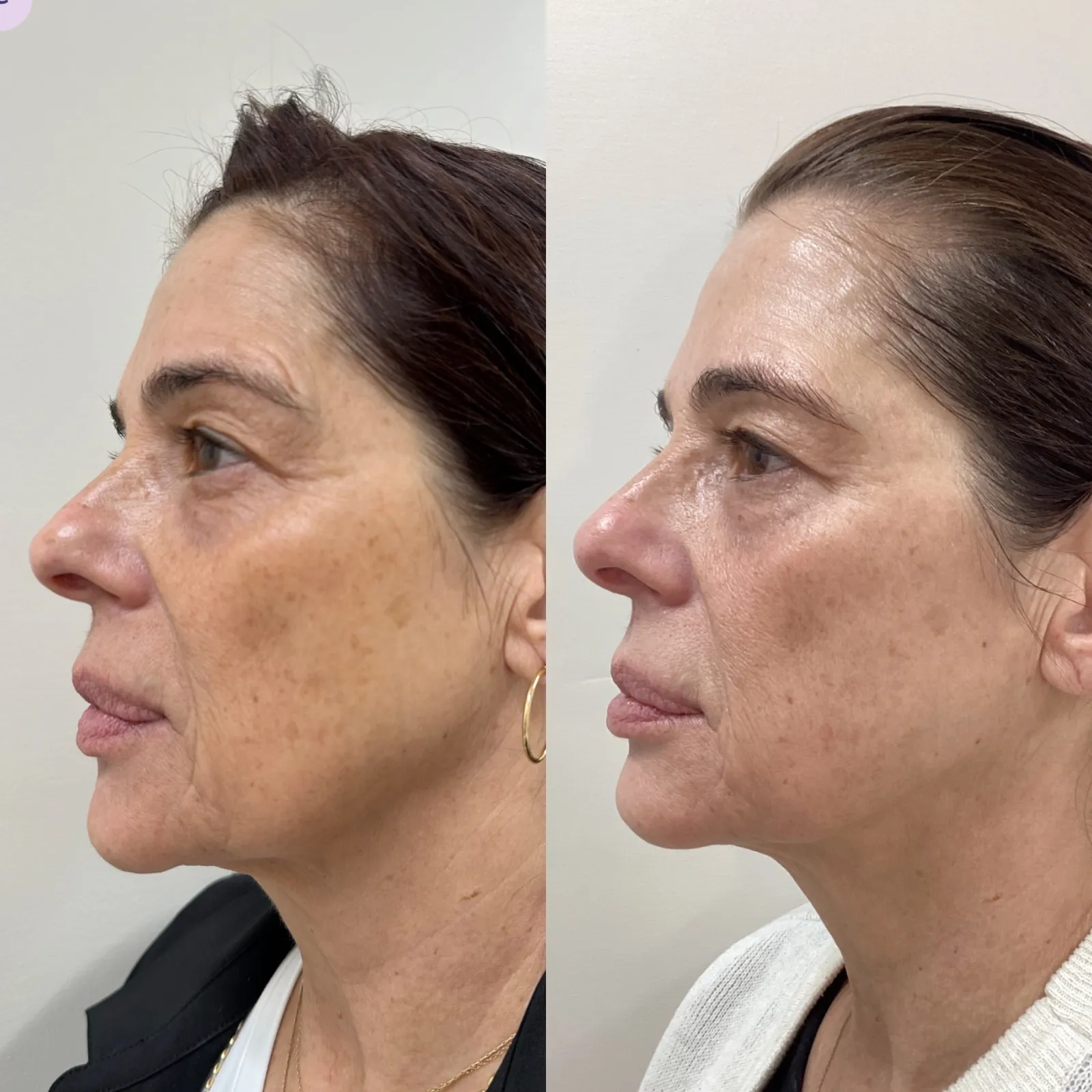 Radiesse for facial structure, profile view of the lower face, before and after, at La Miel Aesthetics in Raleigh, NC