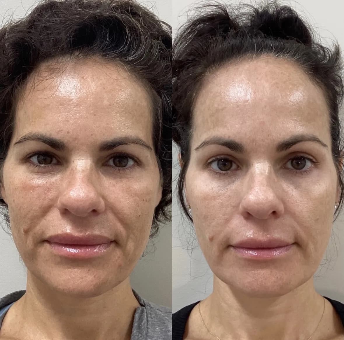 Sculptra for facial volume, front view of the mid-face, before and after, at La Miel Aesthetics in Raleigh, NC