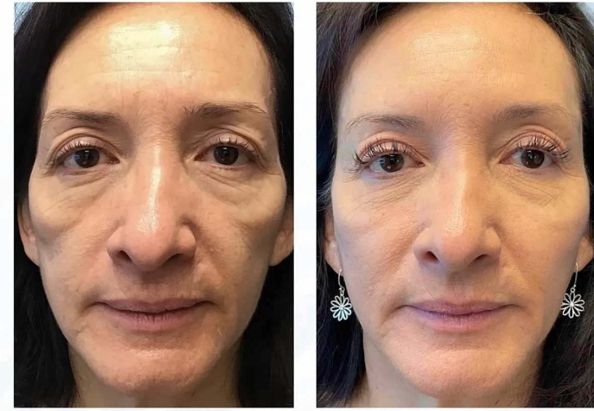 Sculptra for facial volume, front view of the temples, before and after, at La Miel Aesthetics in Raleigh, NC