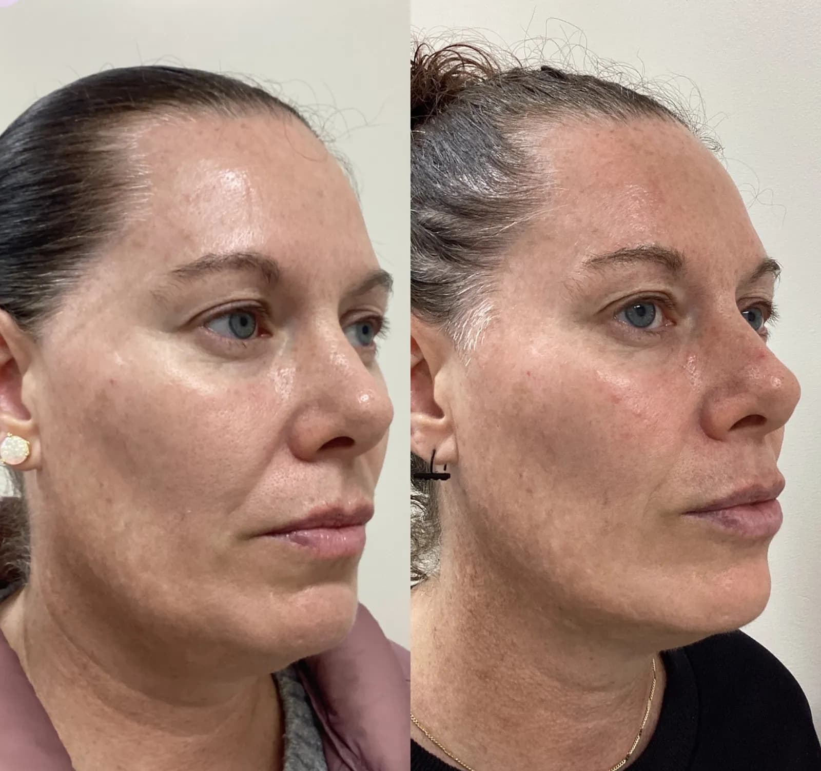 Sculptra for facial volume, three-quarter view of the jawline, before and after, at La Miel Aesthetics in Raleigh, NC