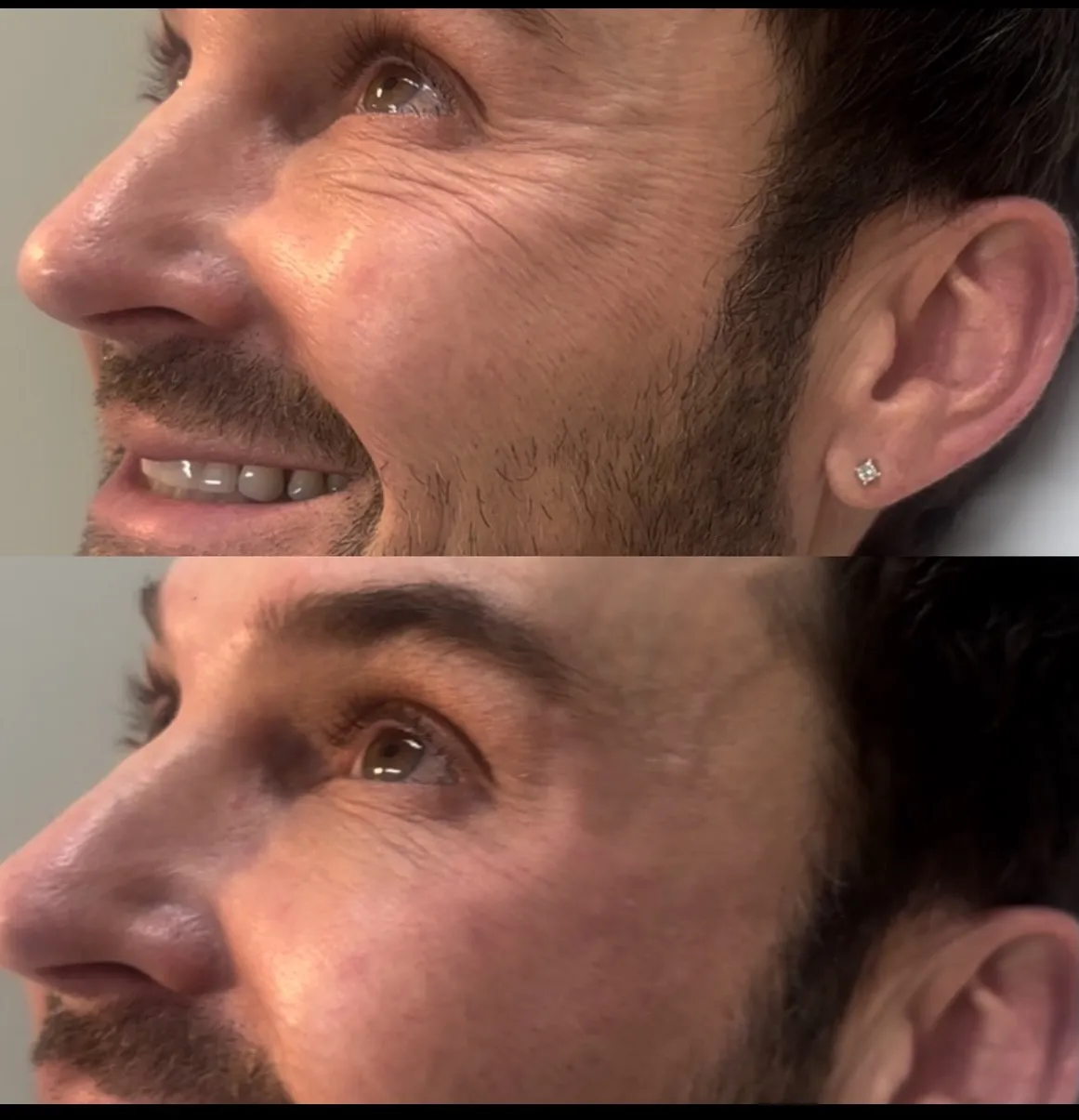 Botox for crow's feet, profile view while smiling, before and after, at La Miel Aesthetics in Raleigh, NC