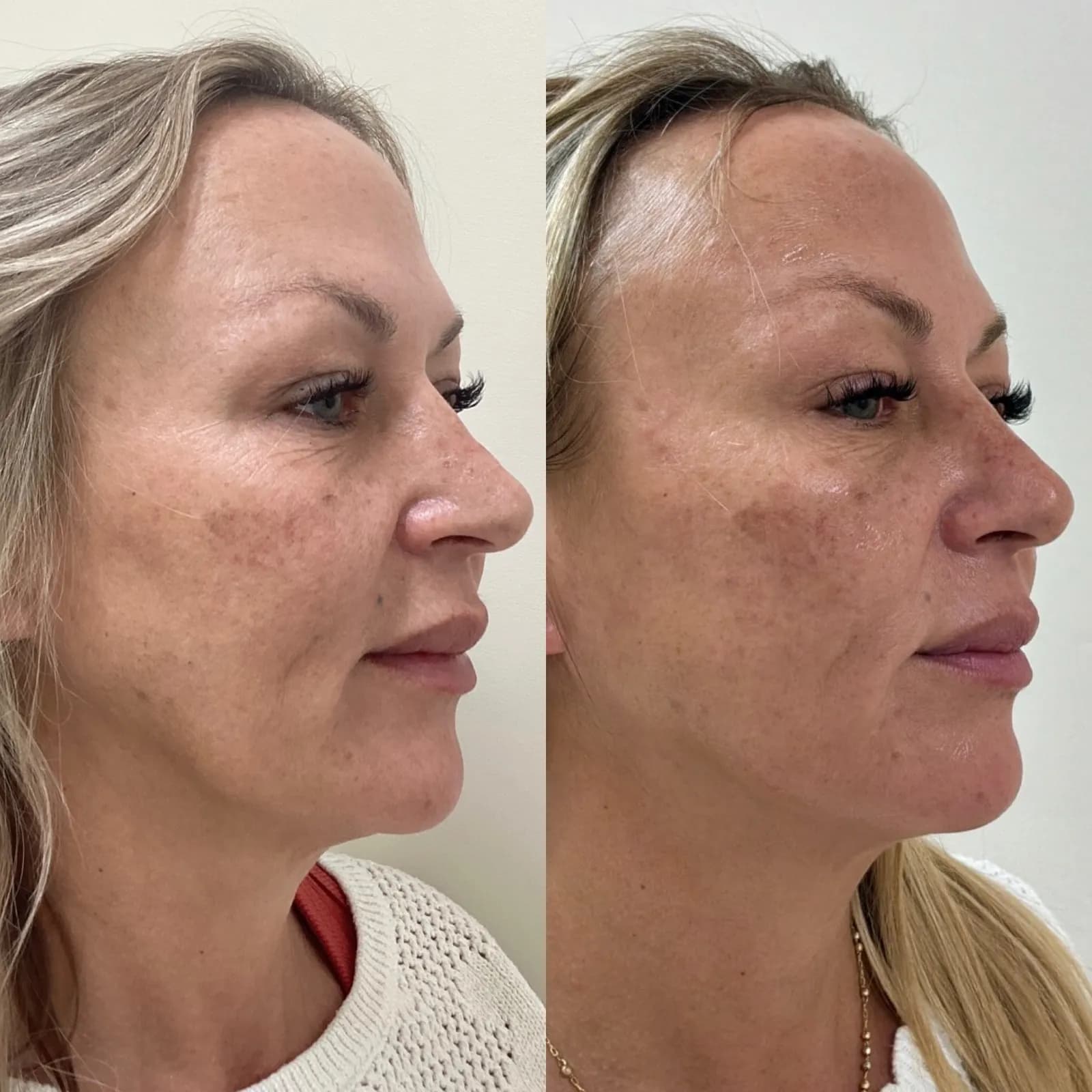 Botox for crow's feet, three-quarter view at rest, before and after, at La Miel Aesthetics in Raleigh, NC