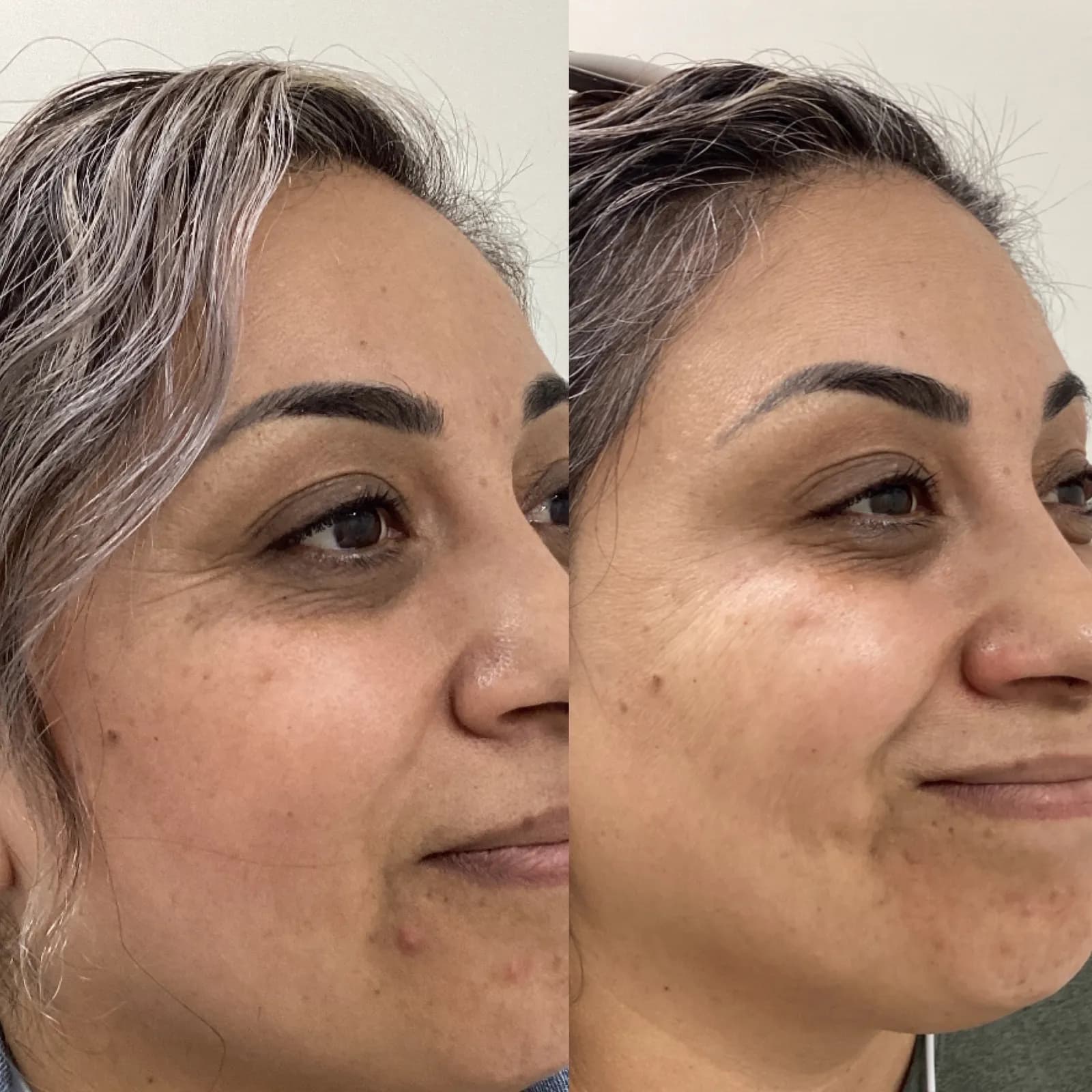 Botox for crow's feet, three-quarter view while smiling, before and after, at La Miel Aesthetics in Raleigh, NC