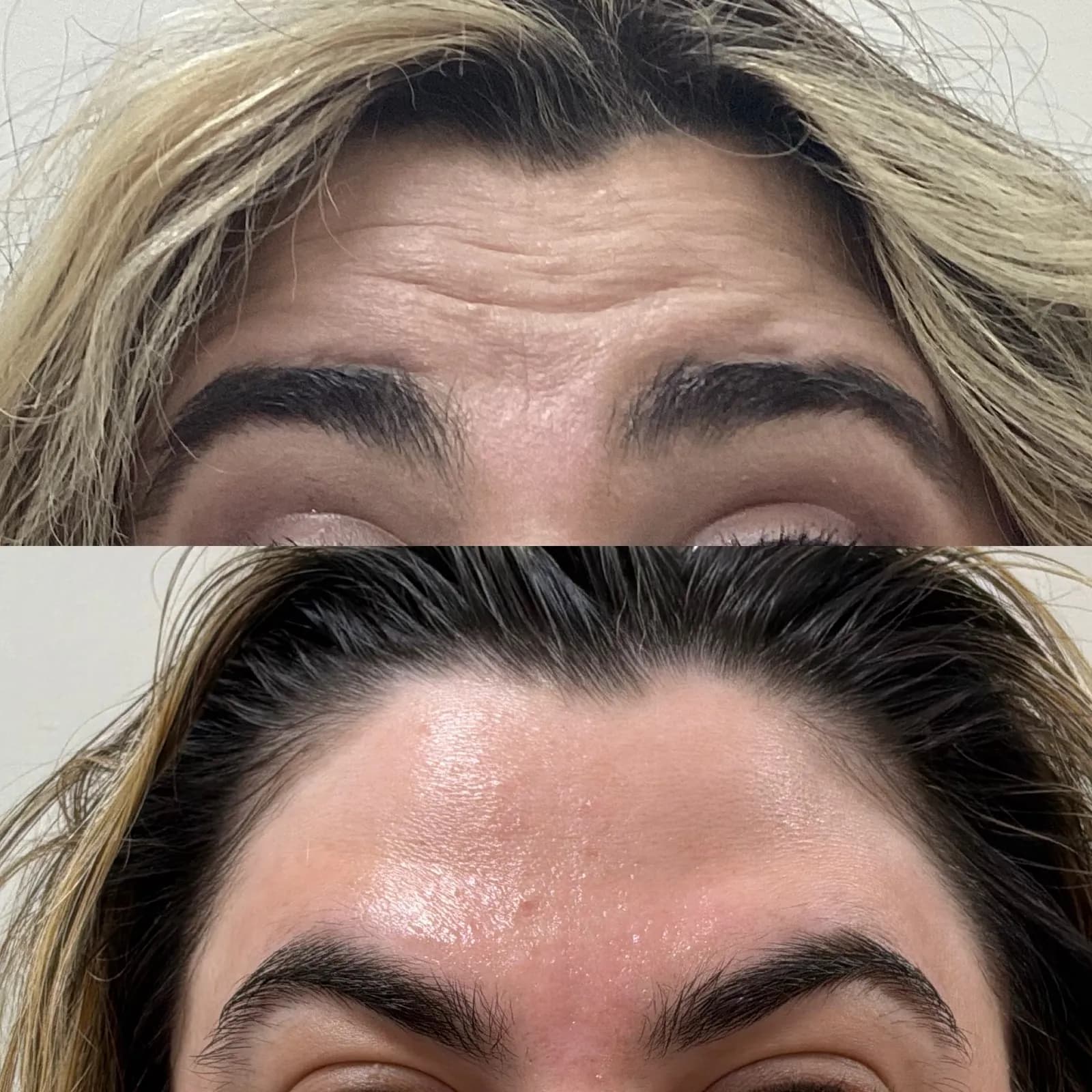 Botox for forehead lines, close-up with raised brows, before and after, at La Miel Aesthetics in Raleigh, NC