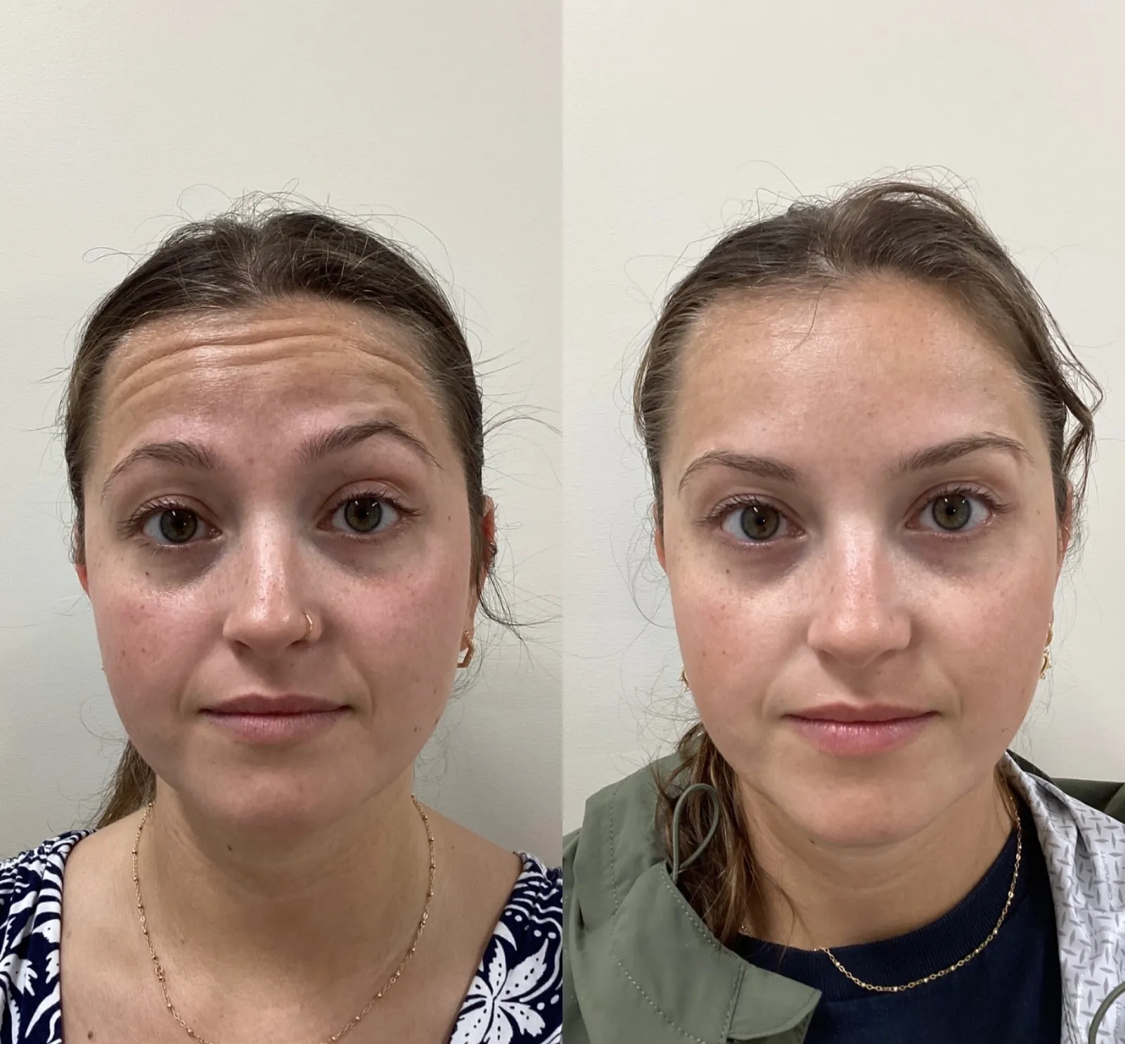 Botox for forehead lines, front view at rest, before and after, at La Miel Aesthetics in Raleigh, NC