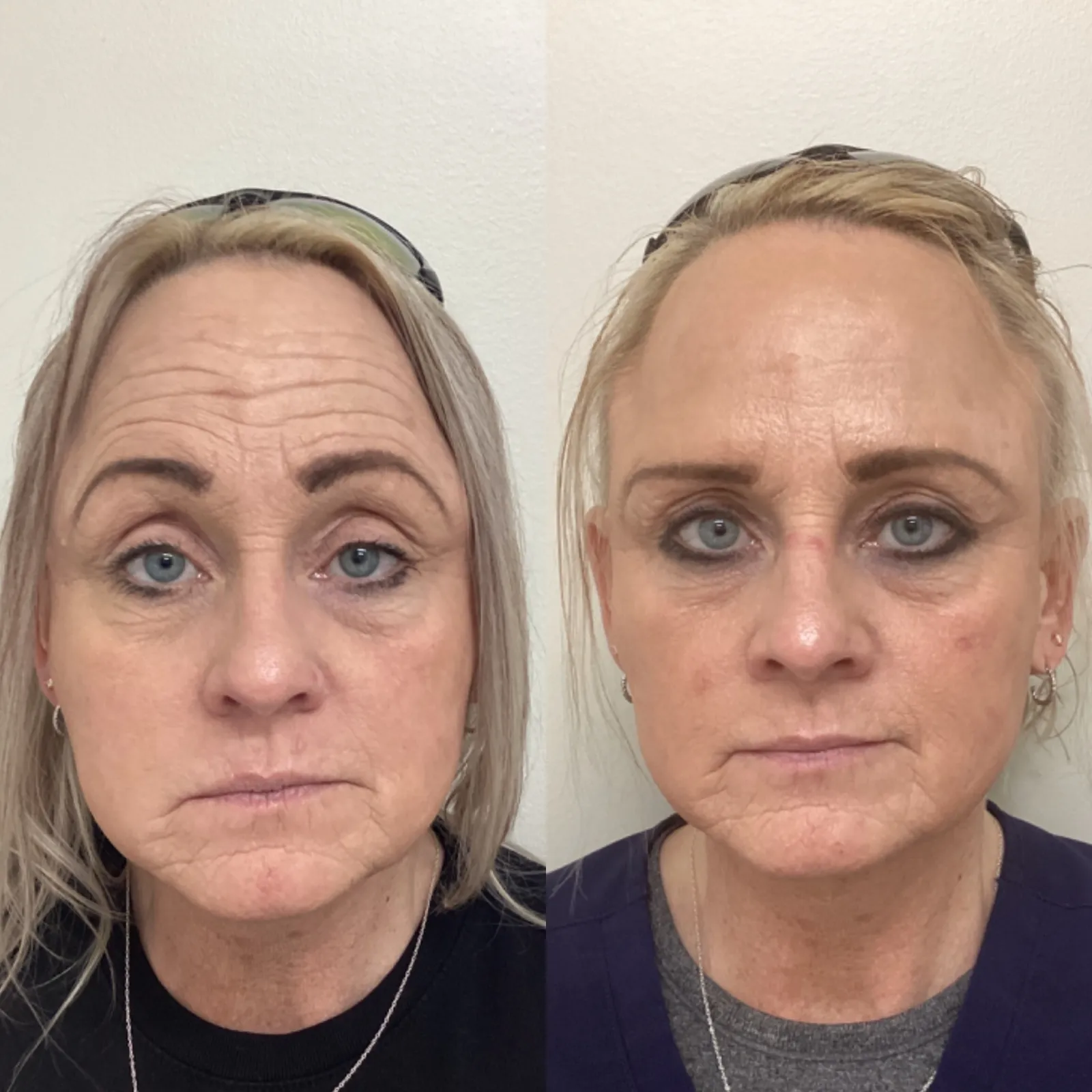 Botox for forehead lines, front view with raised brows, before and after, at La Miel Aesthetics in Raleigh, NC