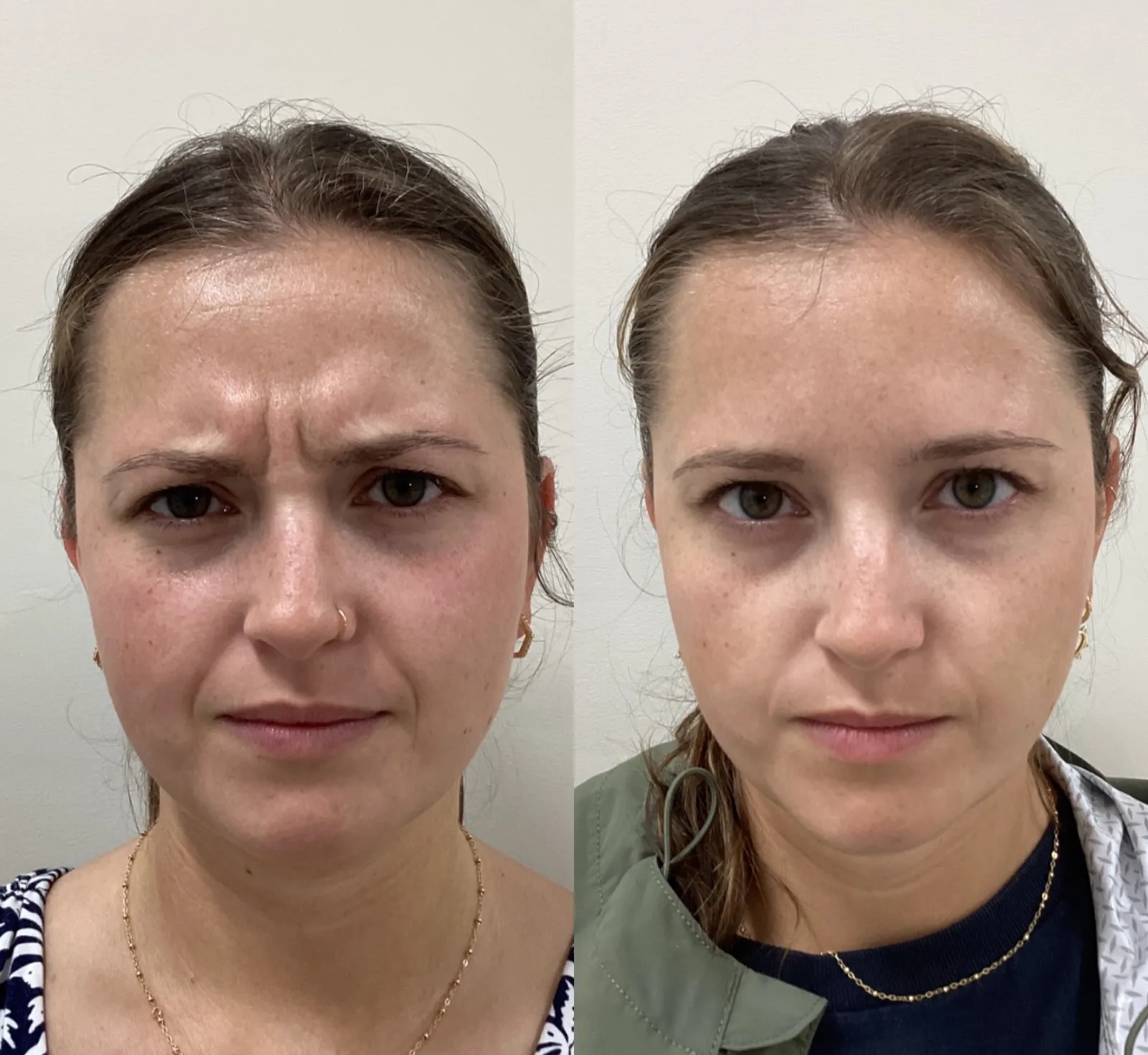 Botox for frown lines (the 11s), front view while frowning, before and after, at La Miel Aesthetics in Raleigh, NC