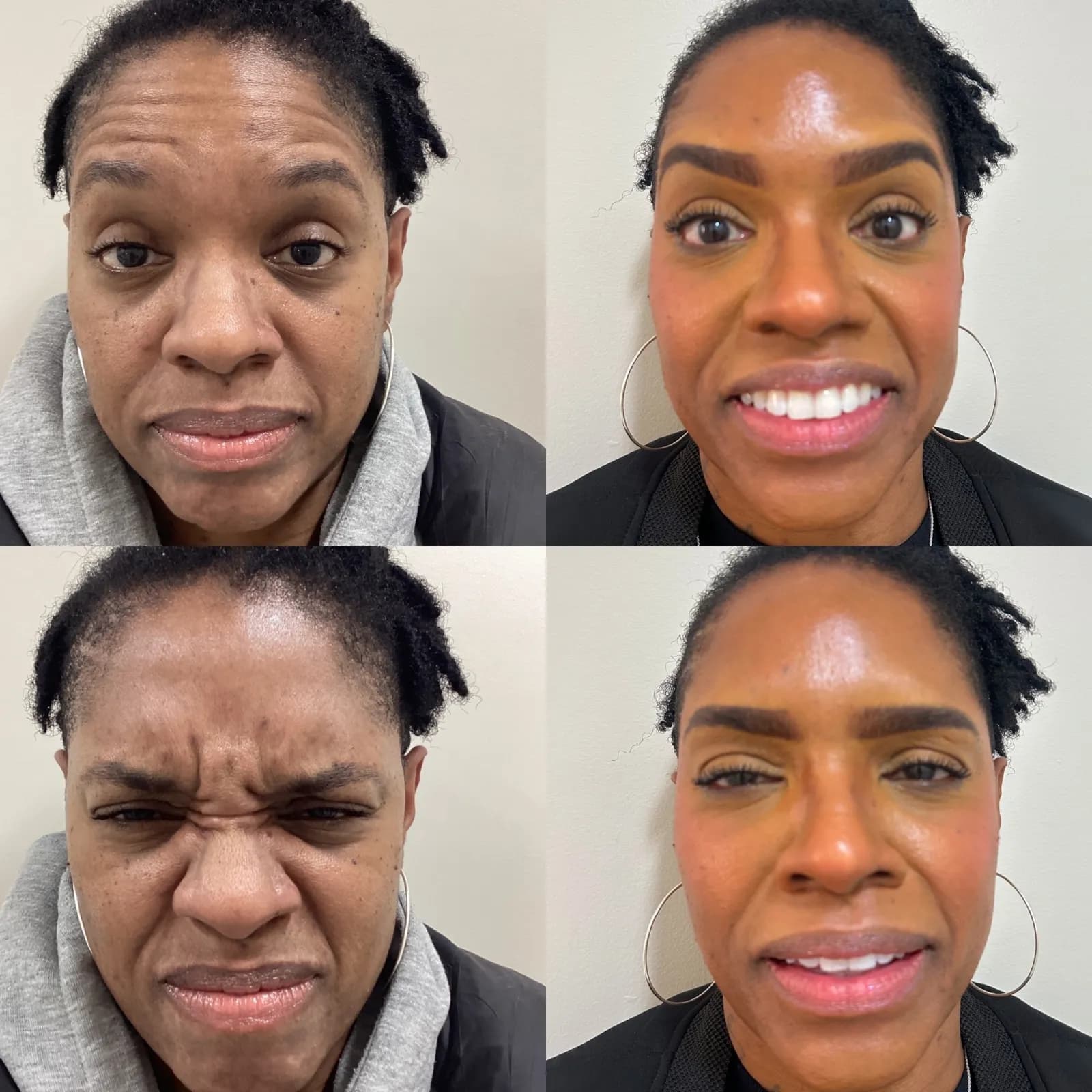 Botox for frown lines (the 11s), front view at rest and with expression, before and after, at La Miel Aesthetics in Raleigh, NC