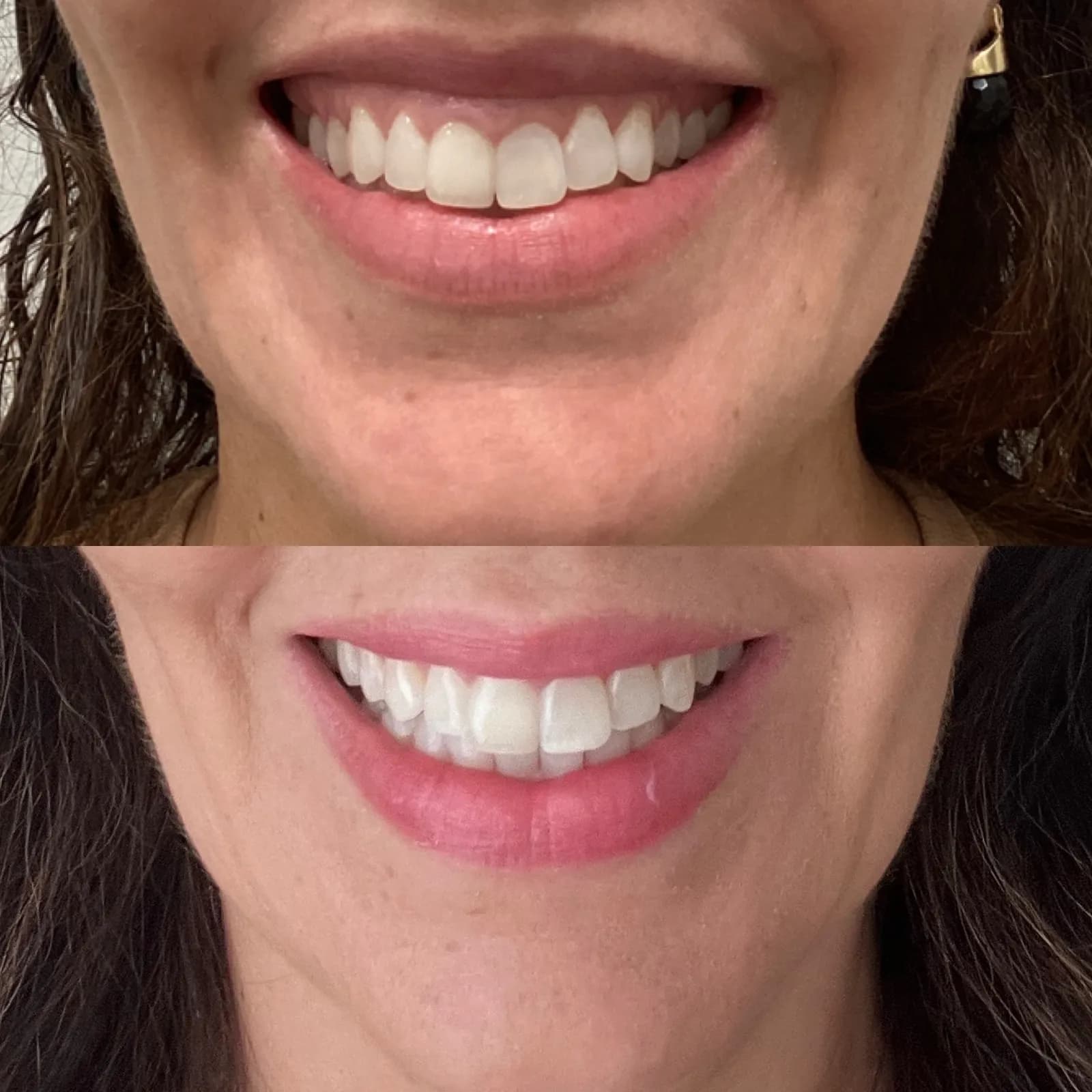 Botox for a lip flip and smile, close-up while smiling, before and after, at La Miel Aesthetics in Raleigh, NC