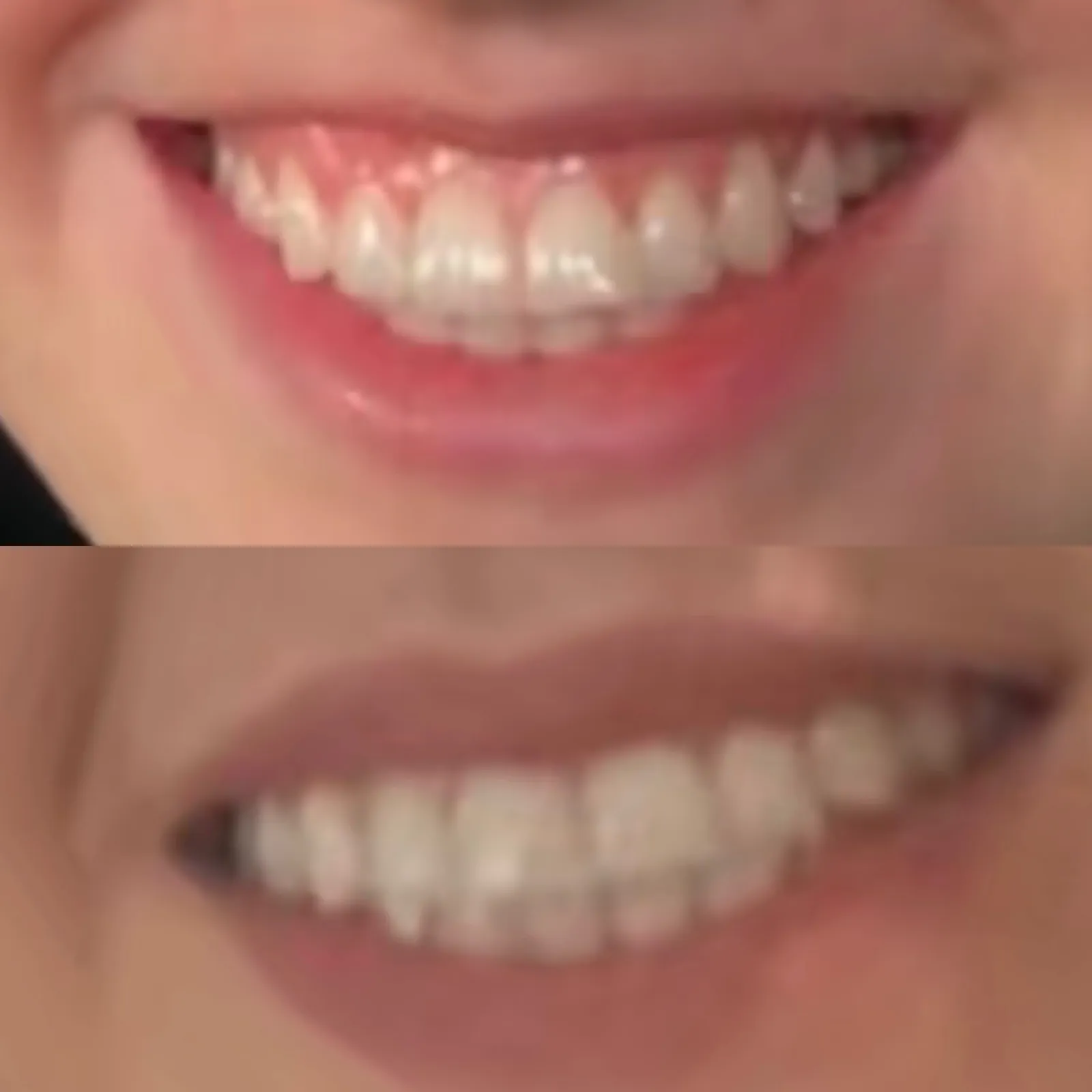 Botox for a lip flip and smile, close-up while smiling, before and after, at La Miel Aesthetics in Raleigh, NC