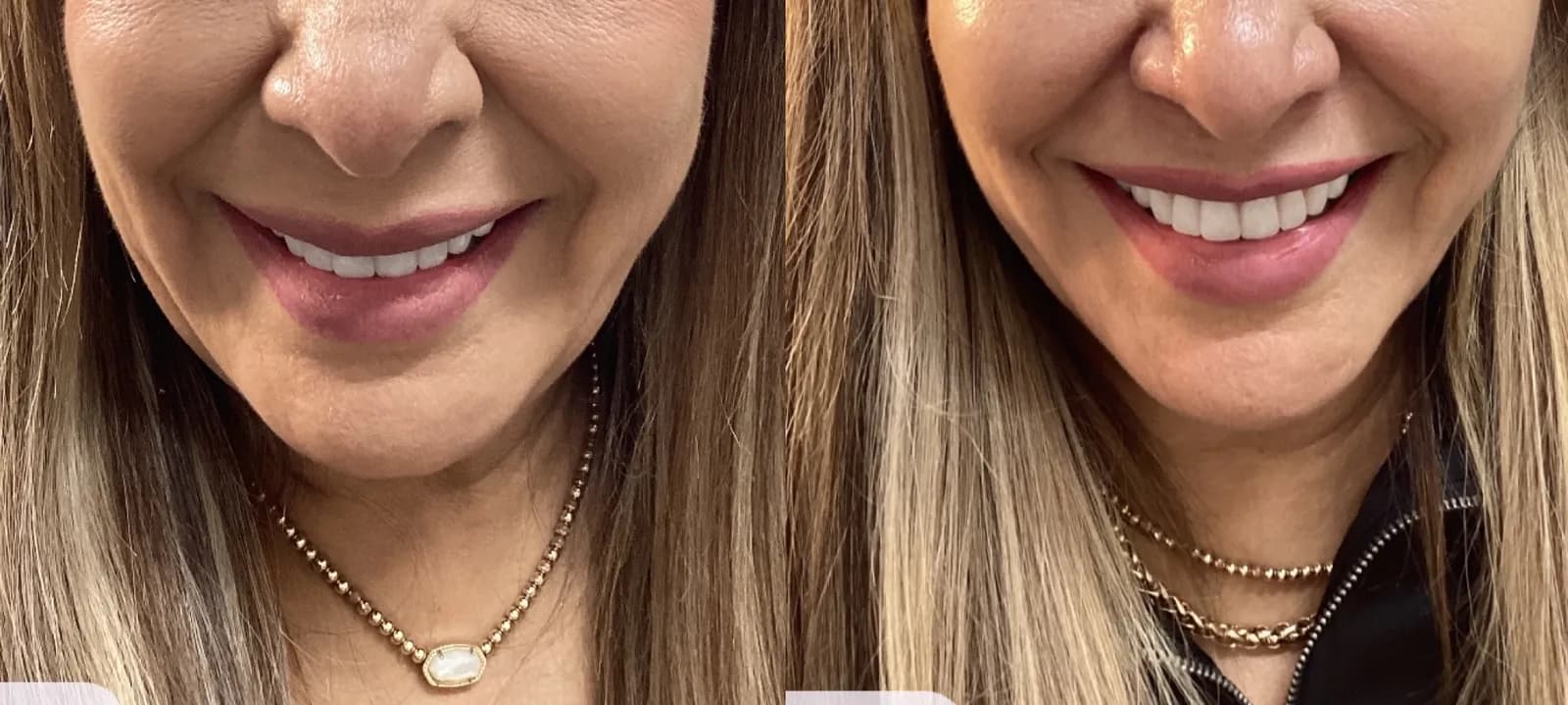 Botox for a lip flip and smile, close-up while smiling, before and after, at La Miel Aesthetics in Raleigh, NC
