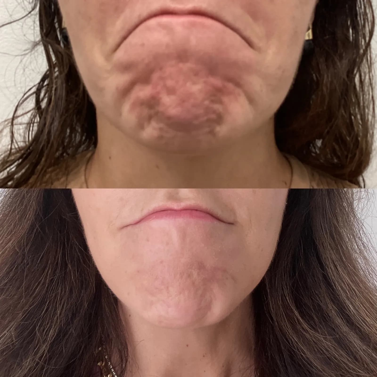 Botox for the chin, jaw, and mouth corners, close-up of chin dimpling, before and after, at La Miel Aesthetics in Raleigh, NC