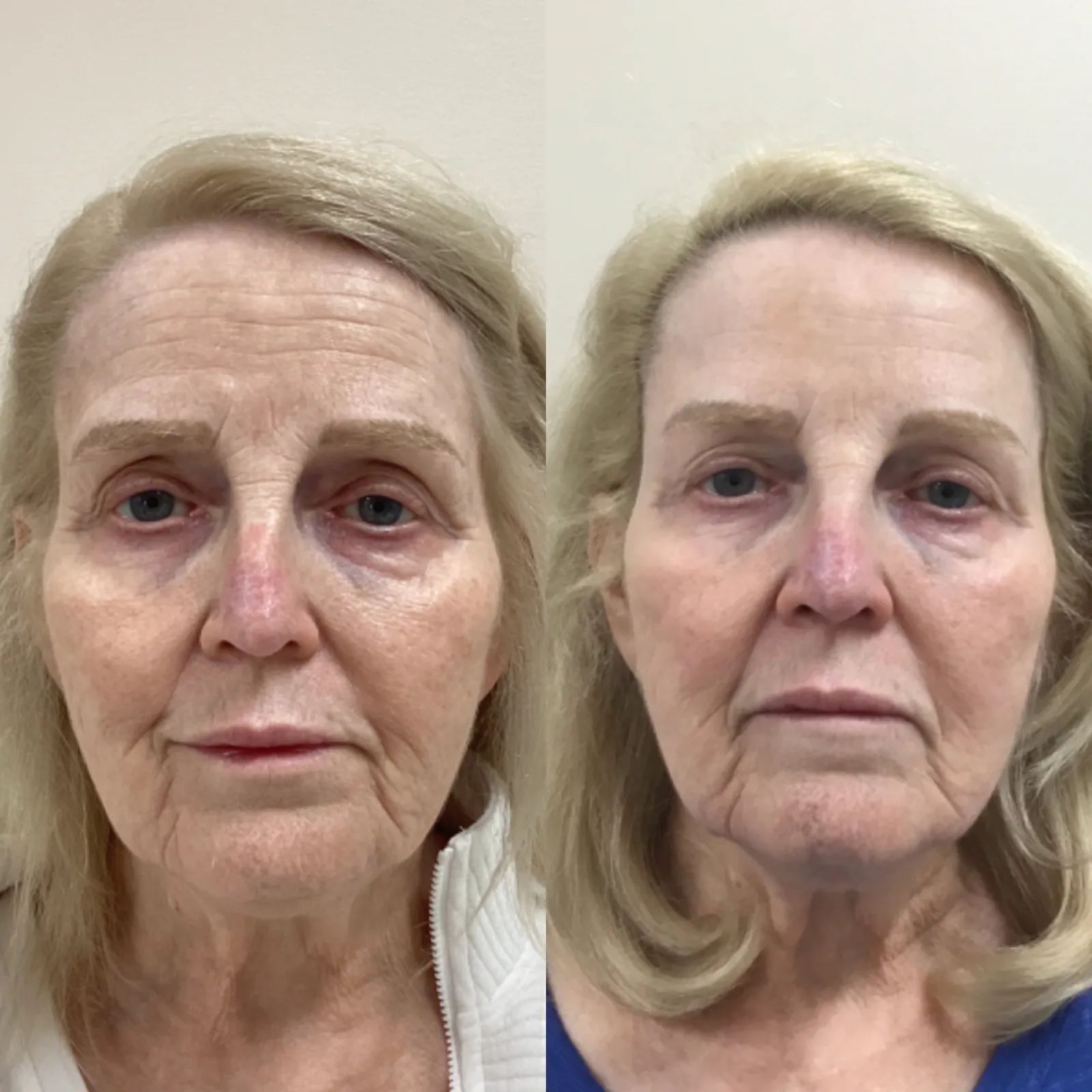 Botox for the upper face, front view at rest, before and after, at La Miel Aesthetics in Raleigh, NC