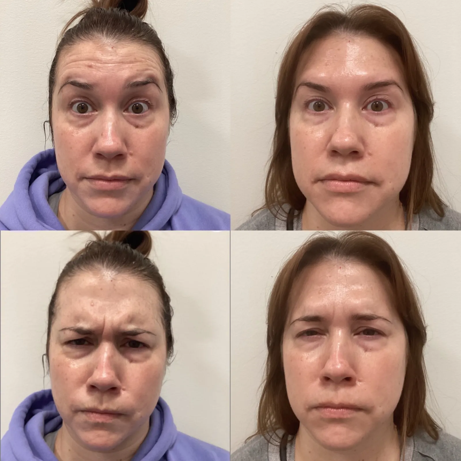 Botox for the upper face, front view at rest and with expression, before and after, at La Miel Aesthetics in Raleigh, NC