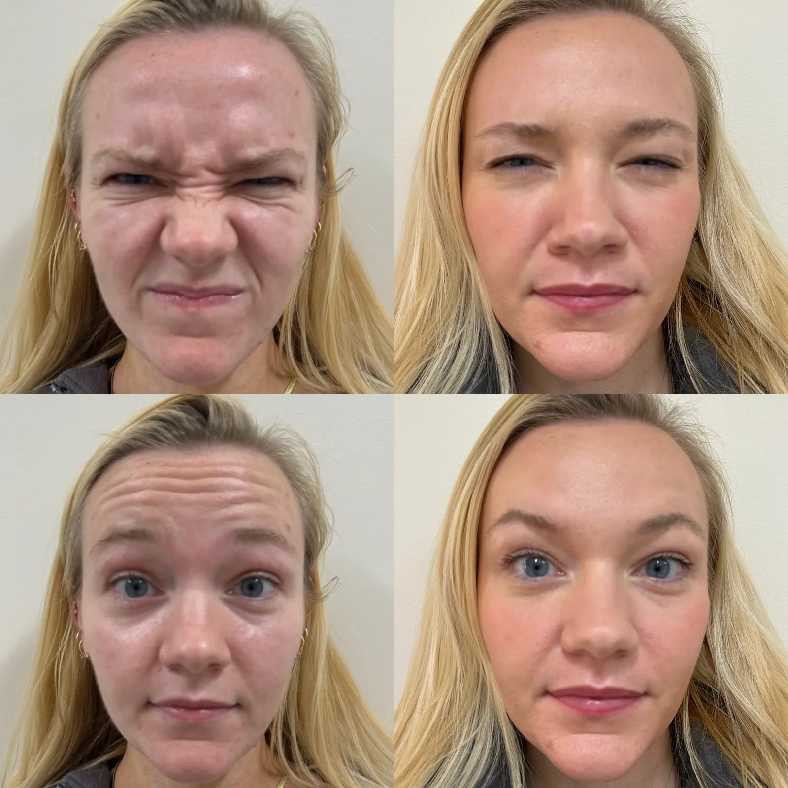 Botox for the upper face, front view at rest and with expression, before and after, at La Miel Aesthetics in Raleigh, NC