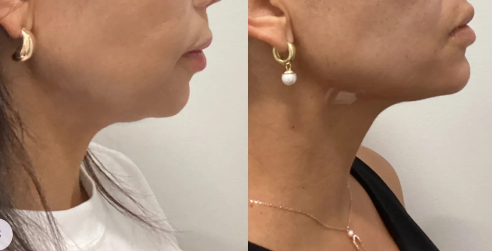 Chin and jawline filler, profile view of the chin, before and after, at La Miel Aesthetics in Raleigh, NC