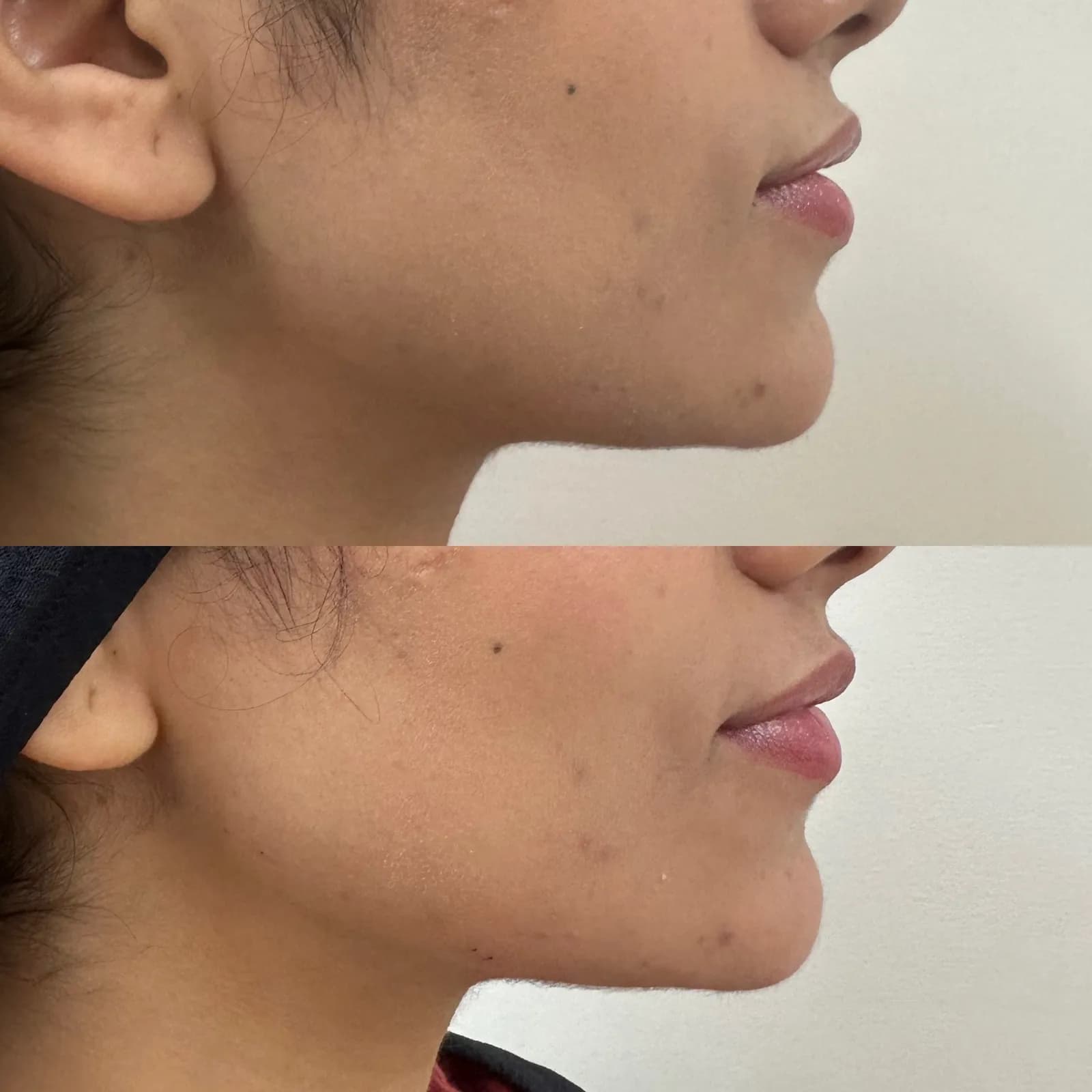 Chin and jawline filler, profile view of the chin, before and after, at La Miel Aesthetics in Raleigh, NC