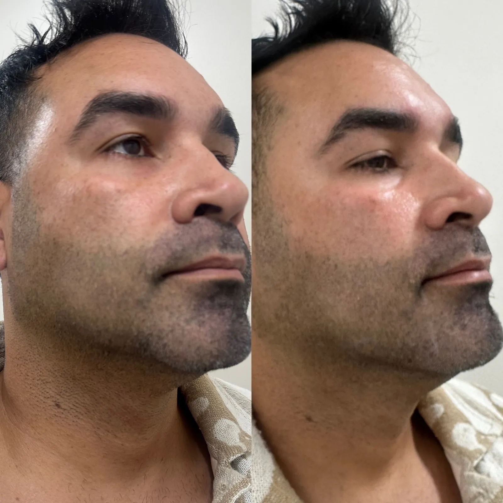 Chin and jawline filler, three-quarter view of the jawline, before and after, at La Miel Aesthetics in Raleigh, NC