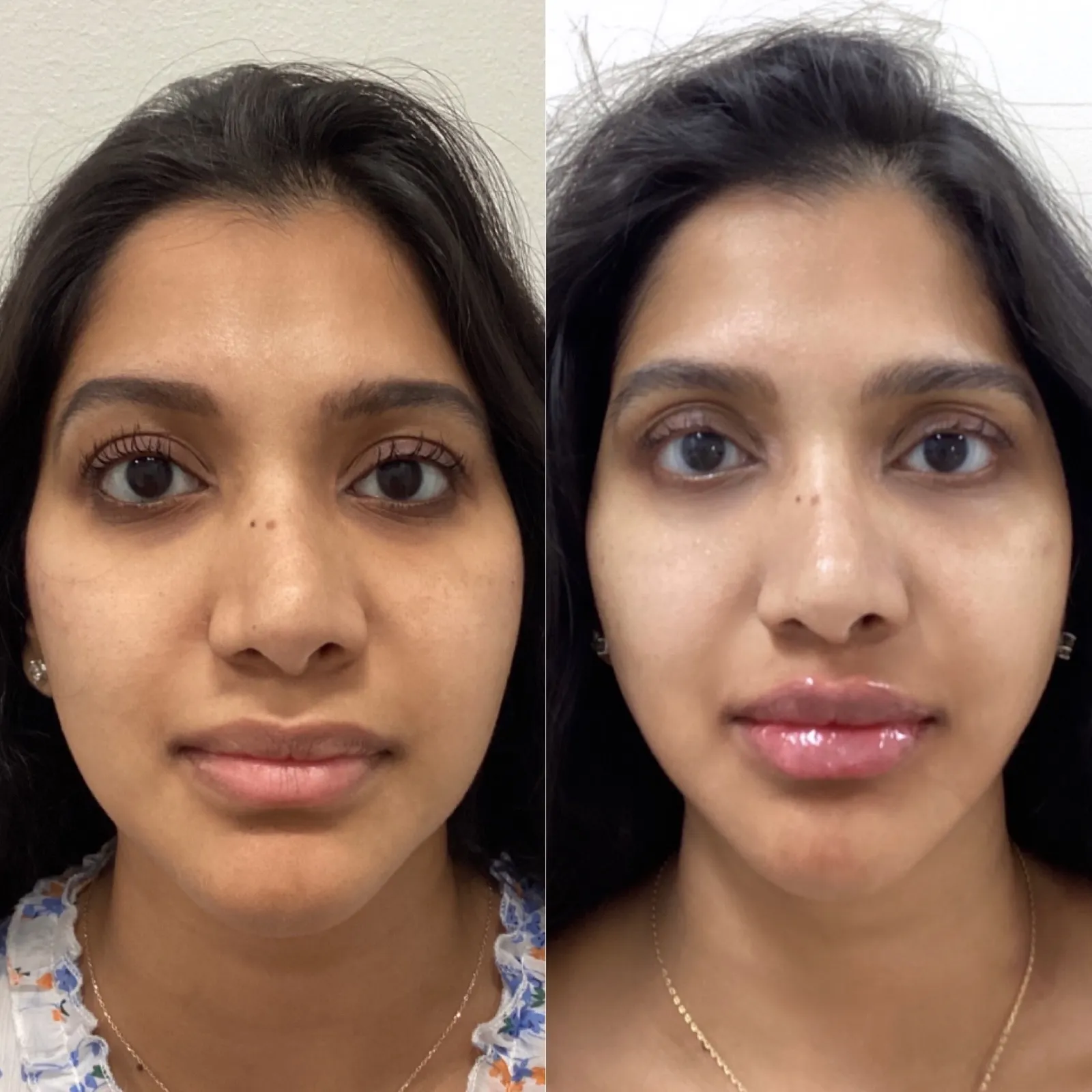 Facial balancing with dermal filler, front view of the lips, before and after, at La Miel Aesthetics in Raleigh, NC