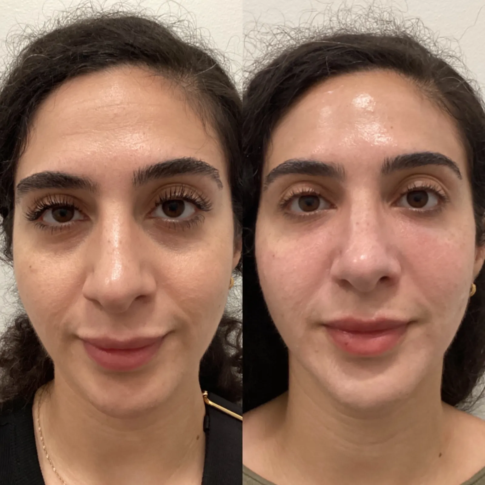 Facial balancing with dermal filler, front view of the lips and cheeks, before and after, at La Miel Aesthetics in Raleigh, NC