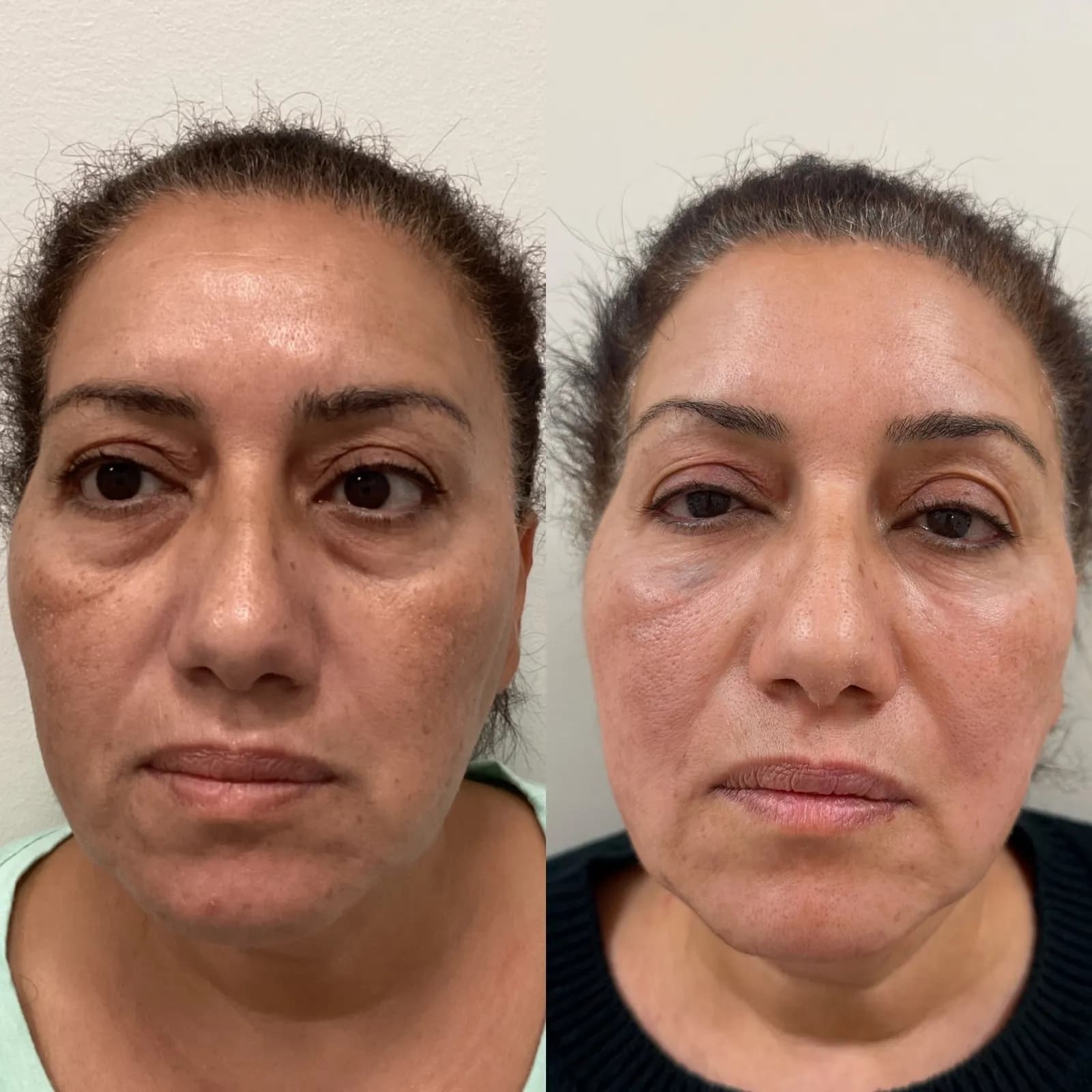 Facial balancing with dermal filler, front view of the under-eye area, before and after, at La Miel Aesthetics in Raleigh, NC