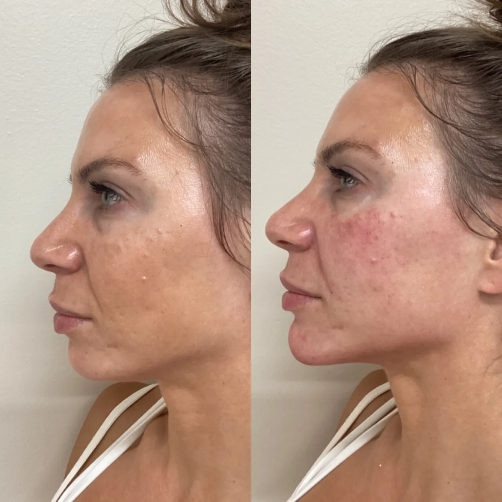 Facial balancing with dermal filler, profile view of the cheeks, before and after, at La Miel Aesthetics in Raleigh, NC