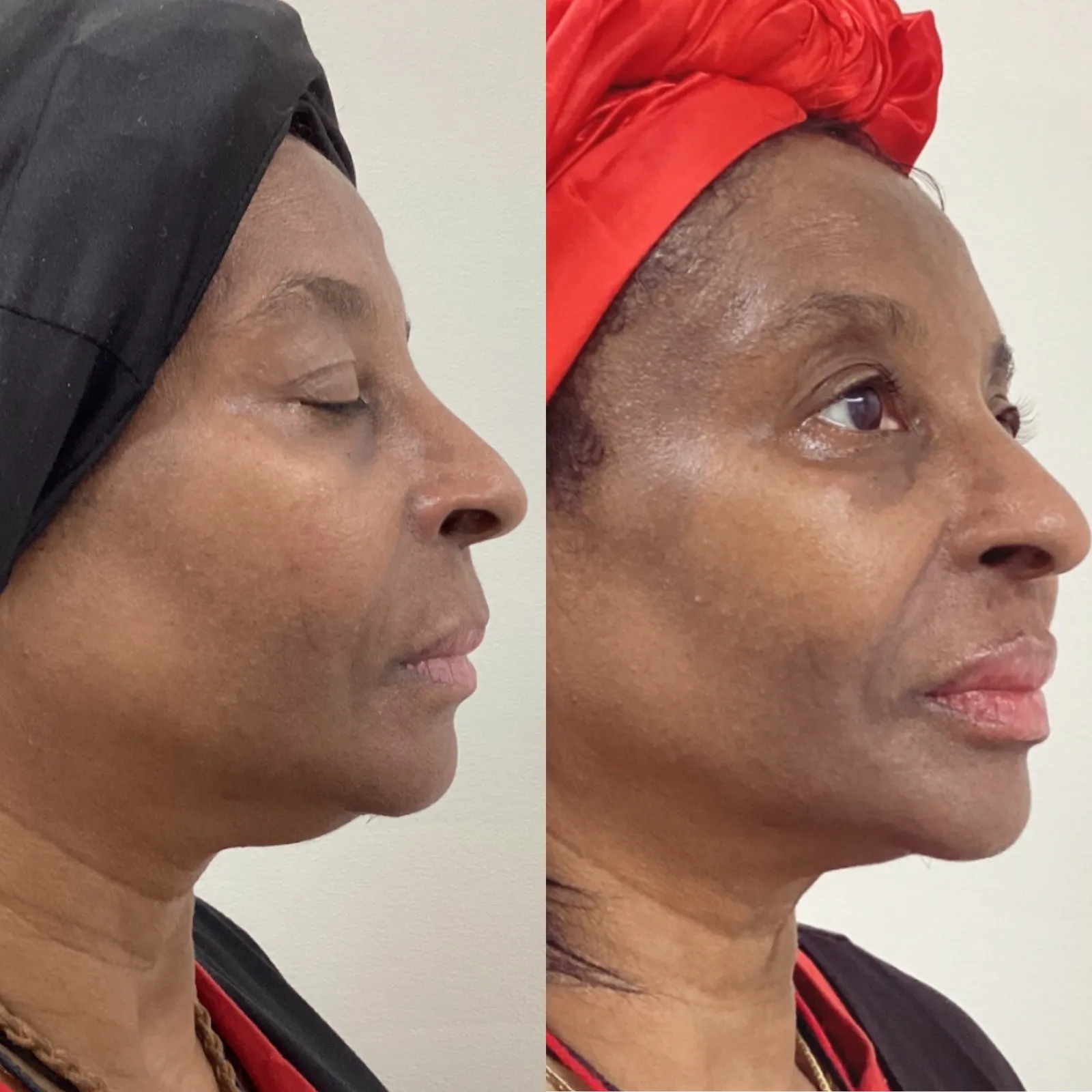 Facial balancing with dermal filler, profile view of the chin and jawline, before and after, at La Miel Aesthetics in Raleigh, NC