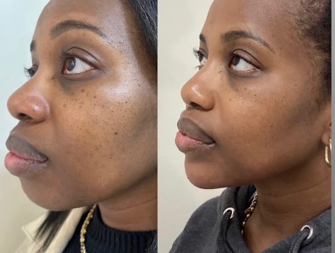 Facial balancing with dermal filler, profile view of the lips and chin, before and after, at La Miel Aesthetics in Raleigh, NC