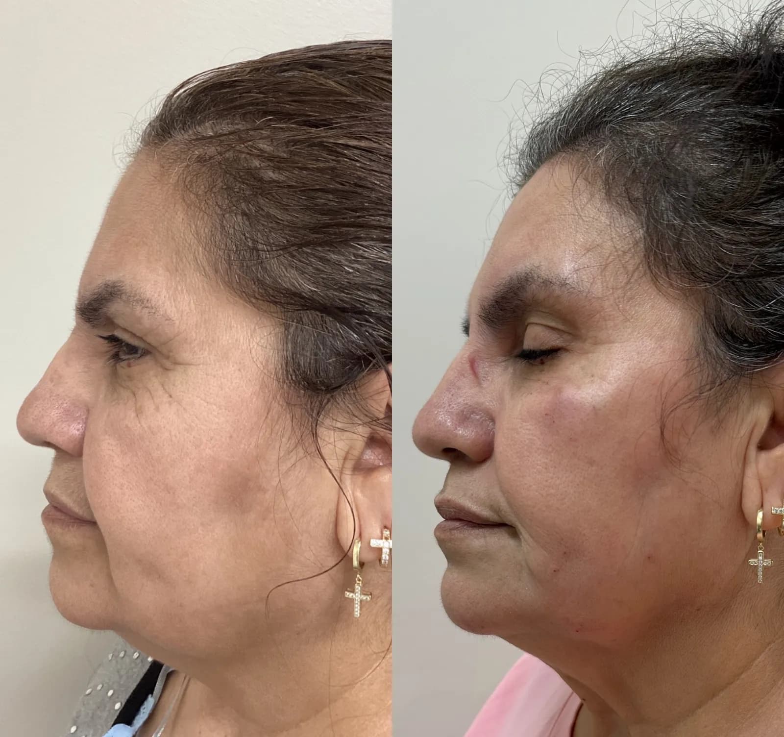 Facial balancing with dermal filler, profile view of the lower face, before and after, at La Miel Aesthetics in Raleigh, NC