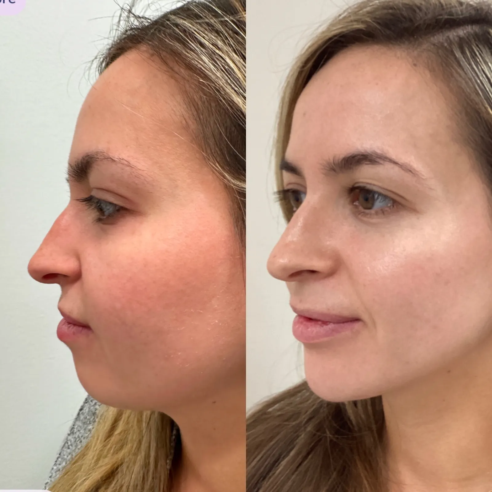 Facial balancing with dermal filler, three-quarter view of the cheeks, before and after, at La Miel Aesthetics in Raleigh, NC