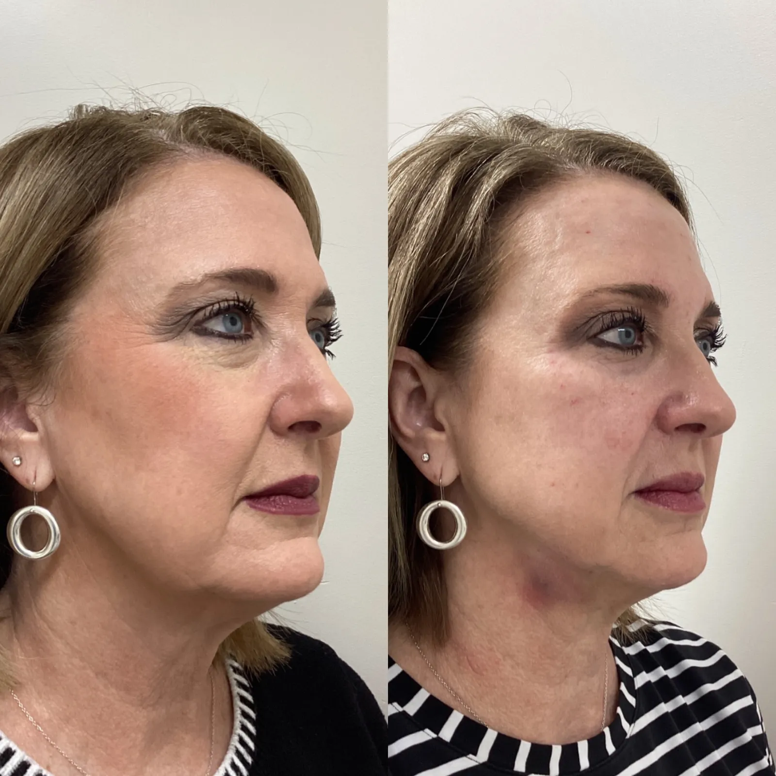 Facial balancing with dermal filler, three-quarter view of the lower face, before and after, at La Miel Aesthetics in Raleigh, NC