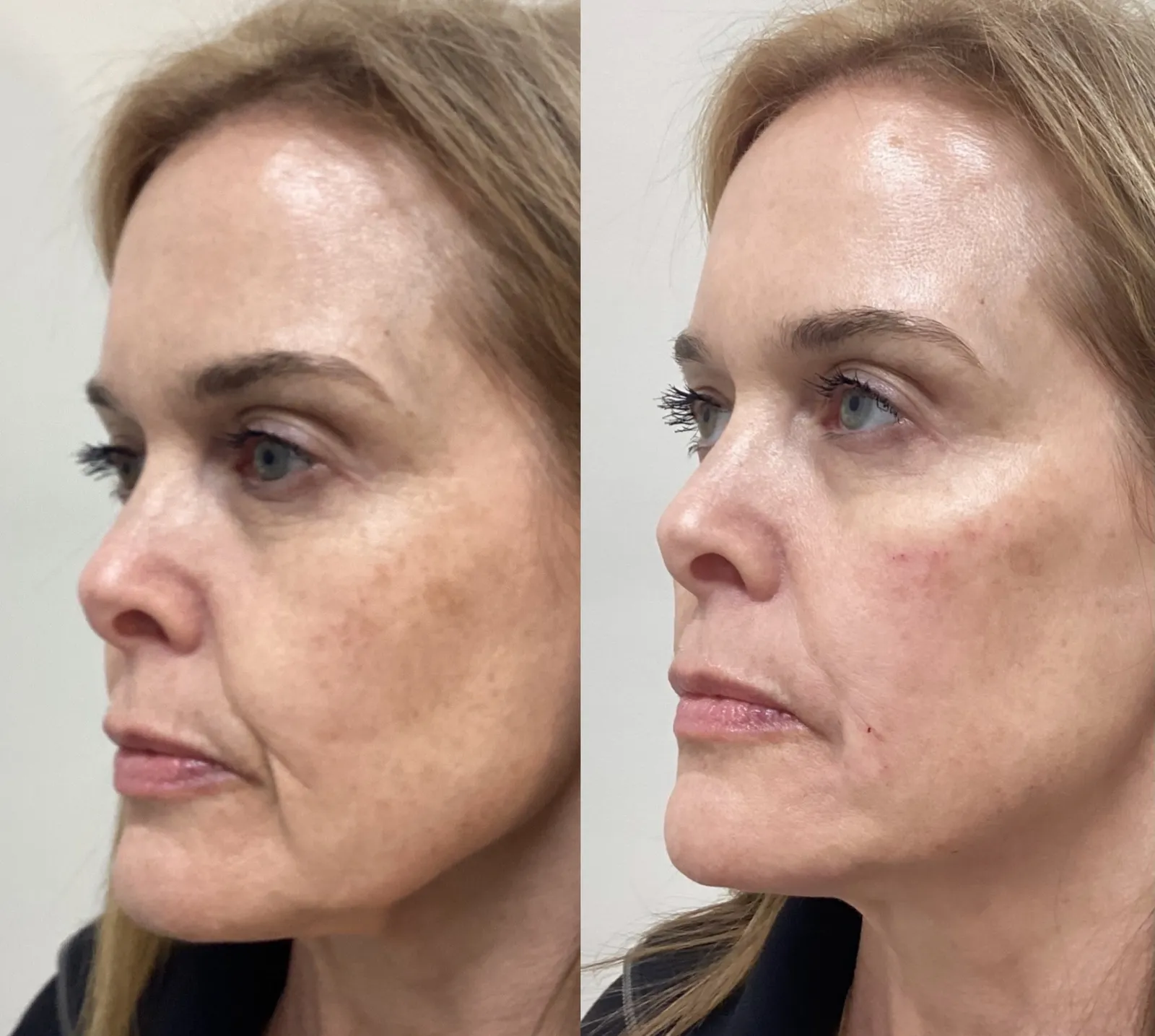 Facial balancing with dermal filler, three-quarter view of the smile lines, before and after, at La Miel Aesthetics in Raleigh, NC