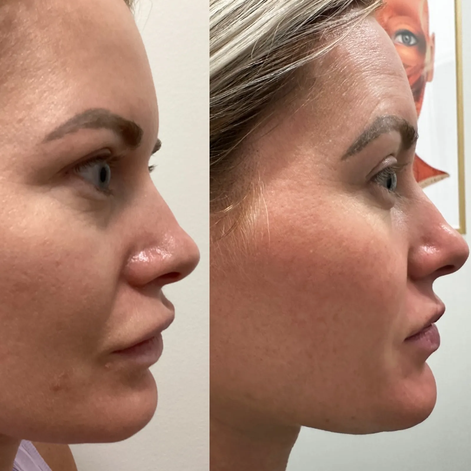 Filler dissolve, profile view of the lips, before and after, at La Miel Aesthetics in Raleigh, NC