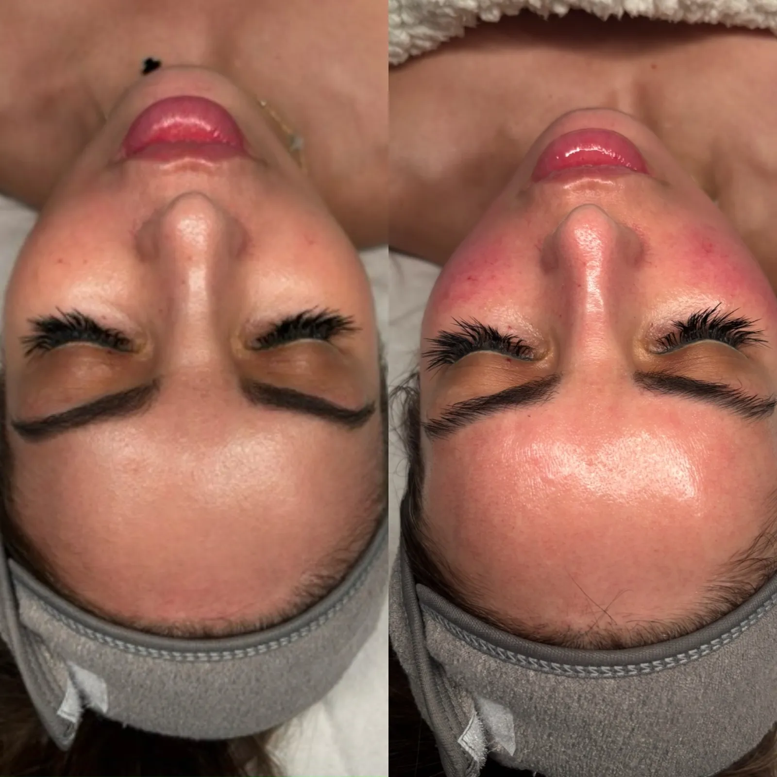 Medical-grade facial, overhead view of the face, before and after, at La Miel Aesthetics in Raleigh, NC