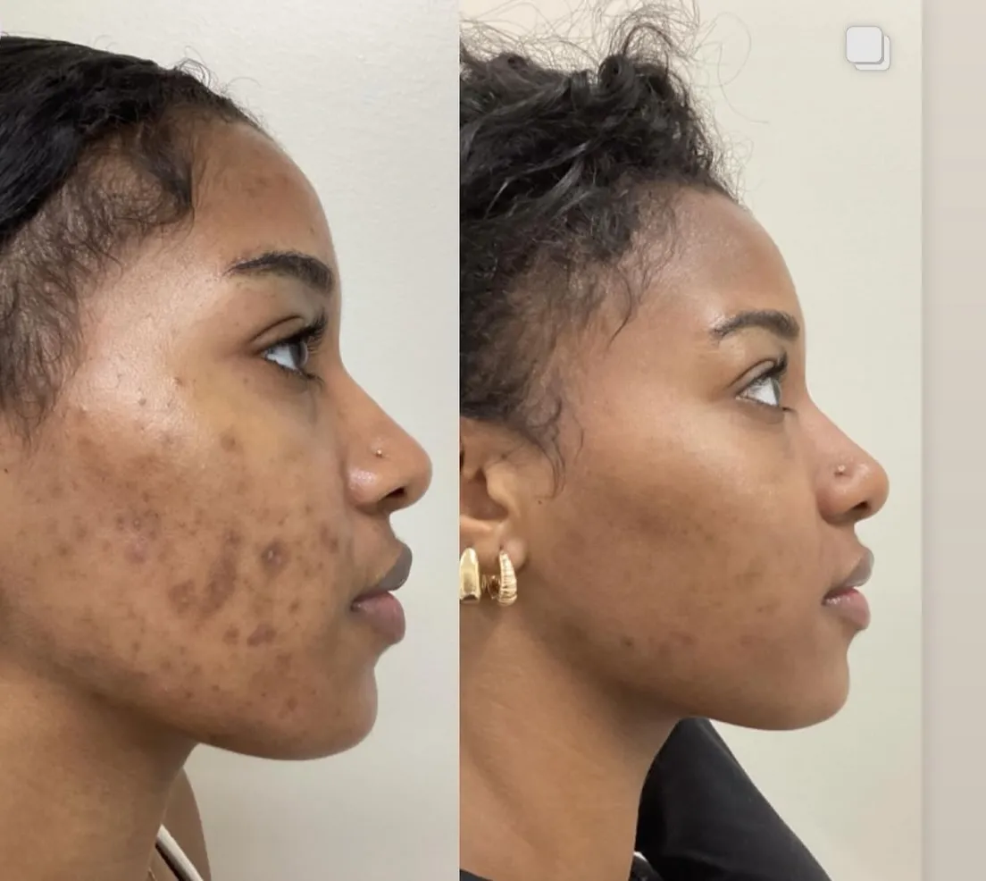 Clear + Brilliant laser for sun spots and pigment, profile view of acne marks, before and after, at La Miel Aesthetics in Raleigh, NC