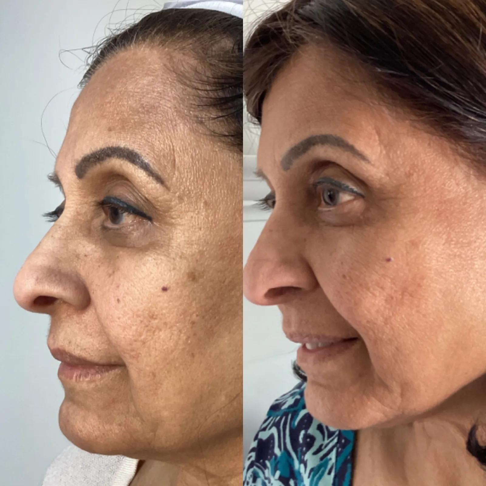 Clear + Brilliant laser for sun spots and pigment, profile view of the cheeks, before and after, at La Miel Aesthetics in Raleigh, NC