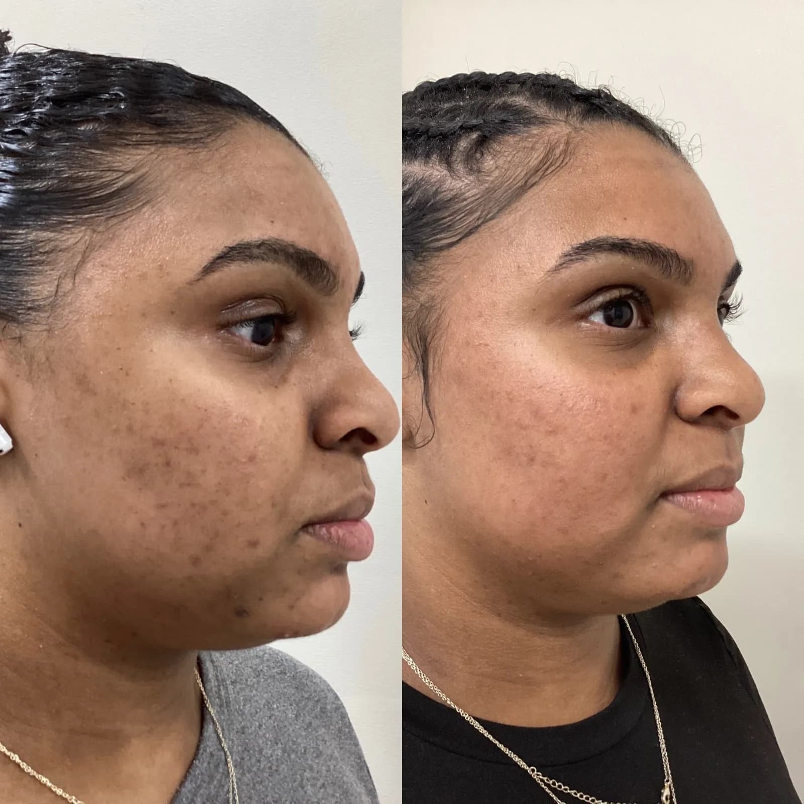Clear + Brilliant laser for sun spots and pigment, three-quarter view of acne marks, before and after, at La Miel Aesthetics in Raleigh, NC