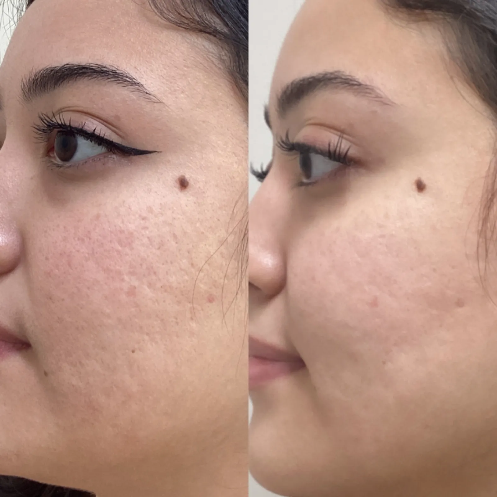 CO2 laser resurfacing for acne scars, three-quarter view of the cheeks, before and after, at La Miel Aesthetics in Raleigh, NC