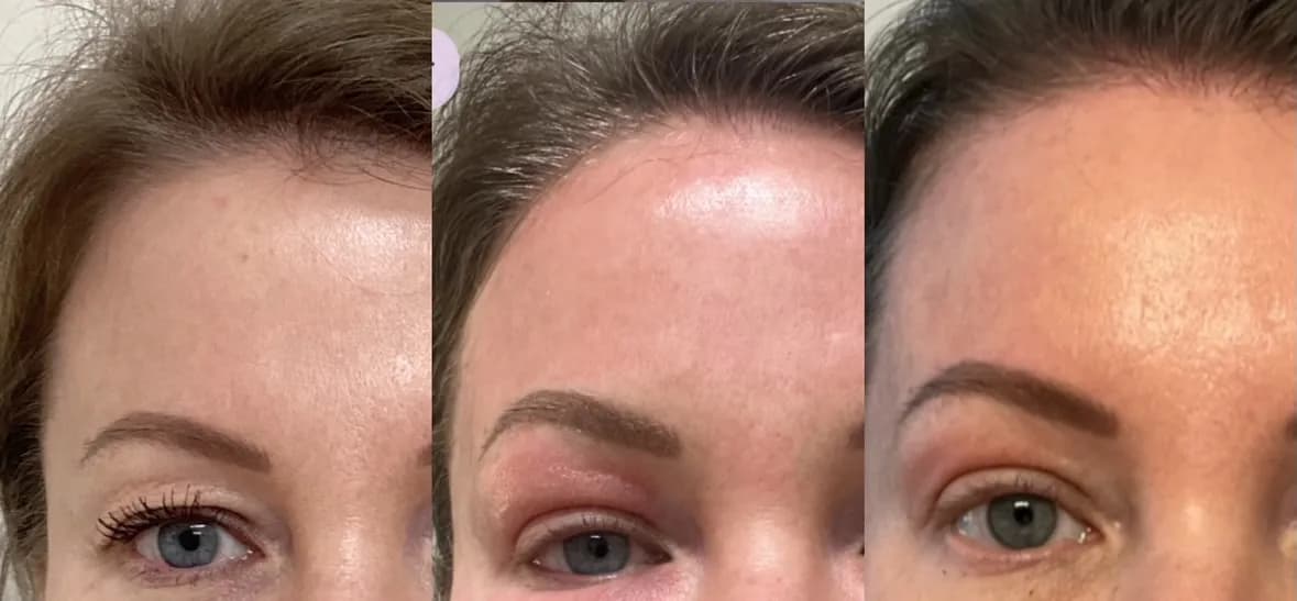 CO2 laser resurfacing for wrinkles and skin texture, close-up of the forehead, before and after, at La Miel Aesthetics in Raleigh, NC