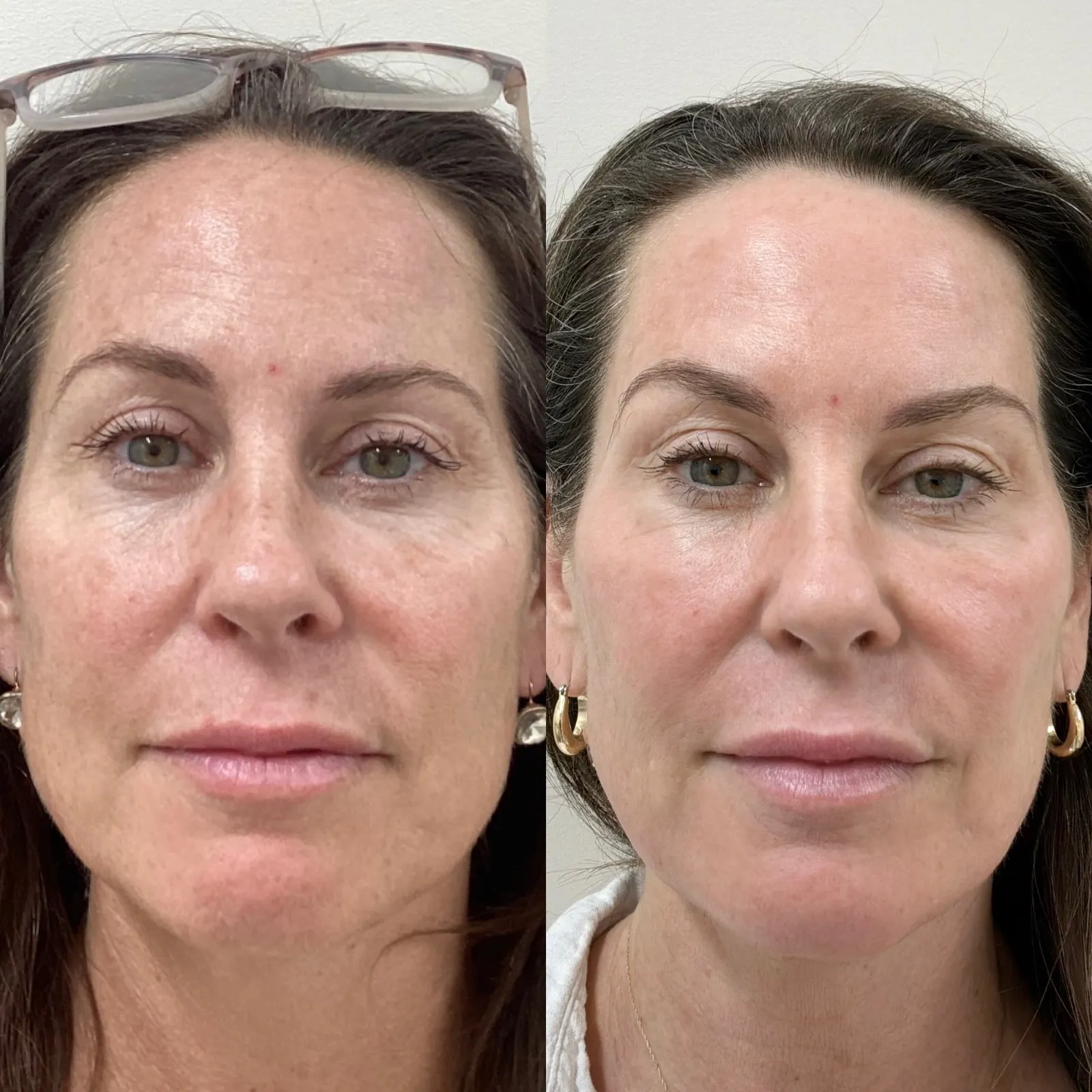 CO2 laser resurfacing for wrinkles and skin texture, front view of the full face, before and after, at La Miel Aesthetics in Raleigh, NC