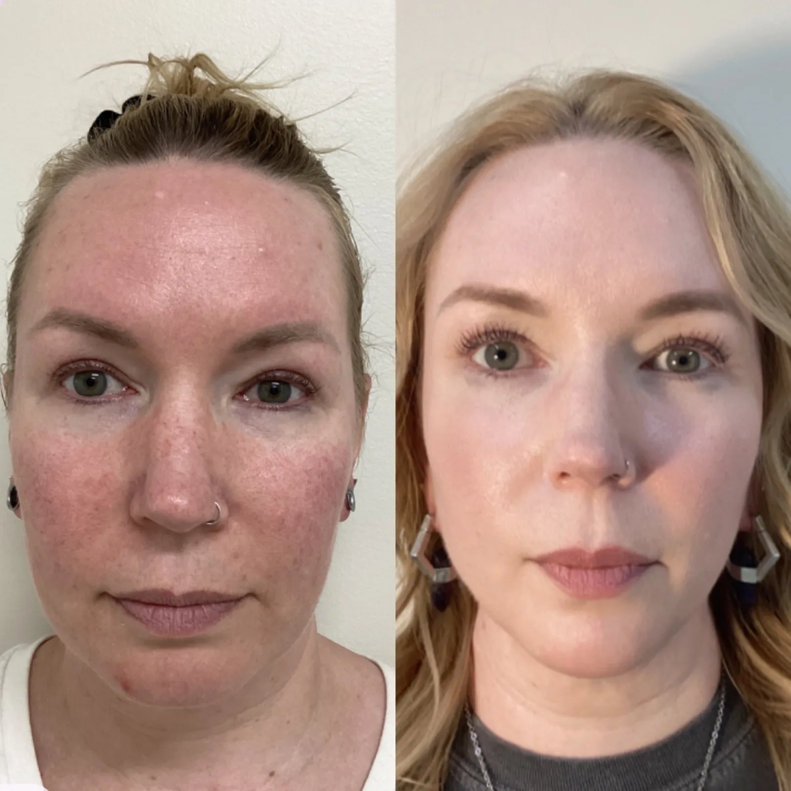 IPL photofacial for redness, front view of the full face, before and after, at La Miel Aesthetics in Raleigh, NC