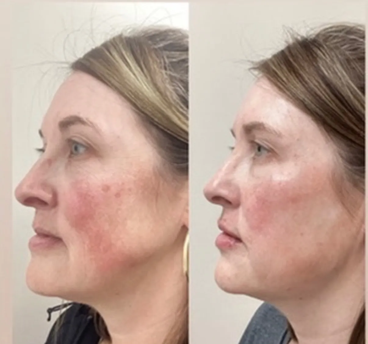 Laser treatment for redness, three-quarter view of the cheeks, before and after, at La Miel Aesthetics in Raleigh, NC