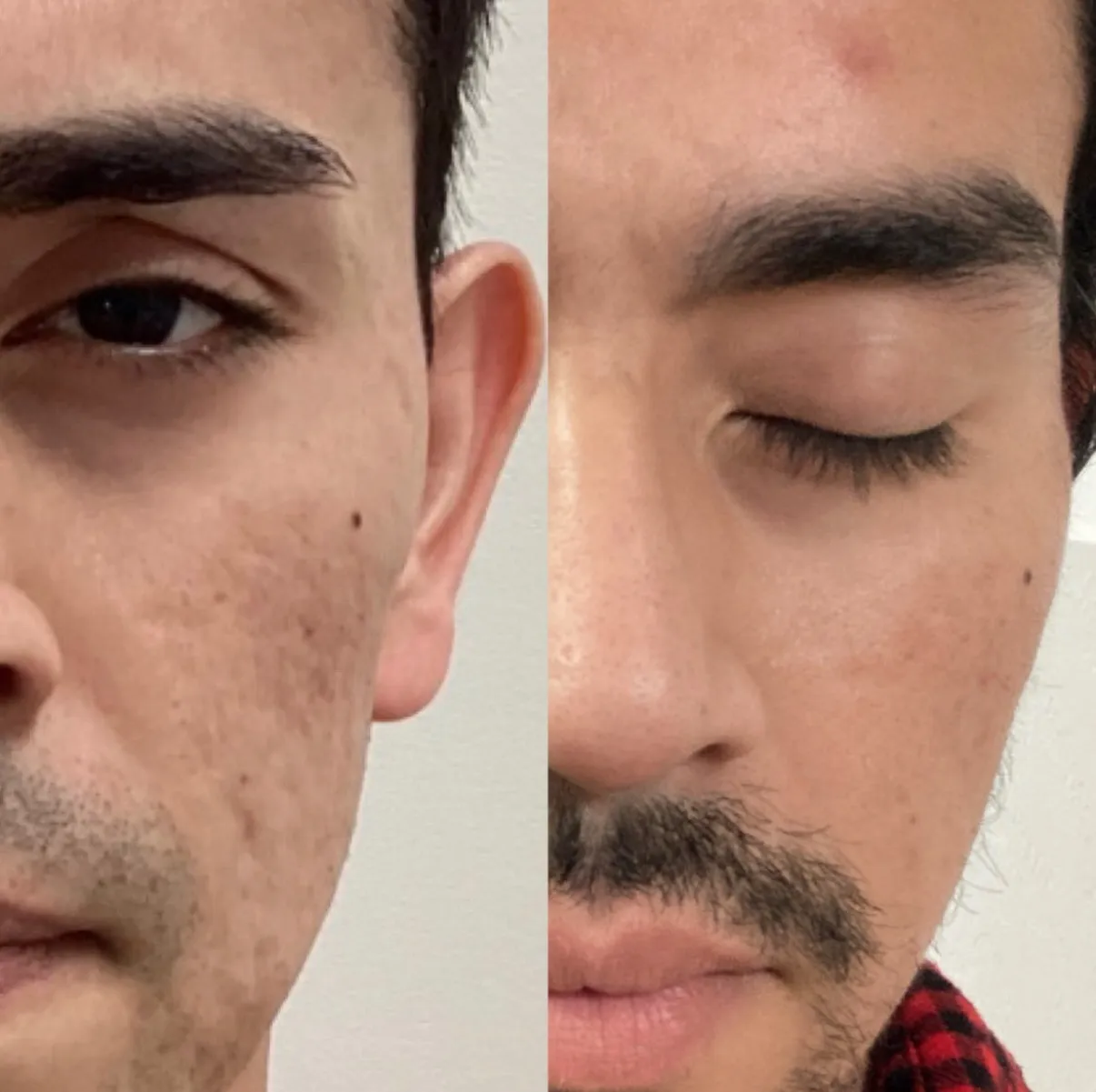 Laser treatment for acne scars, close-up of the cheeks, before and after, at La Miel Aesthetics in Raleigh, NC