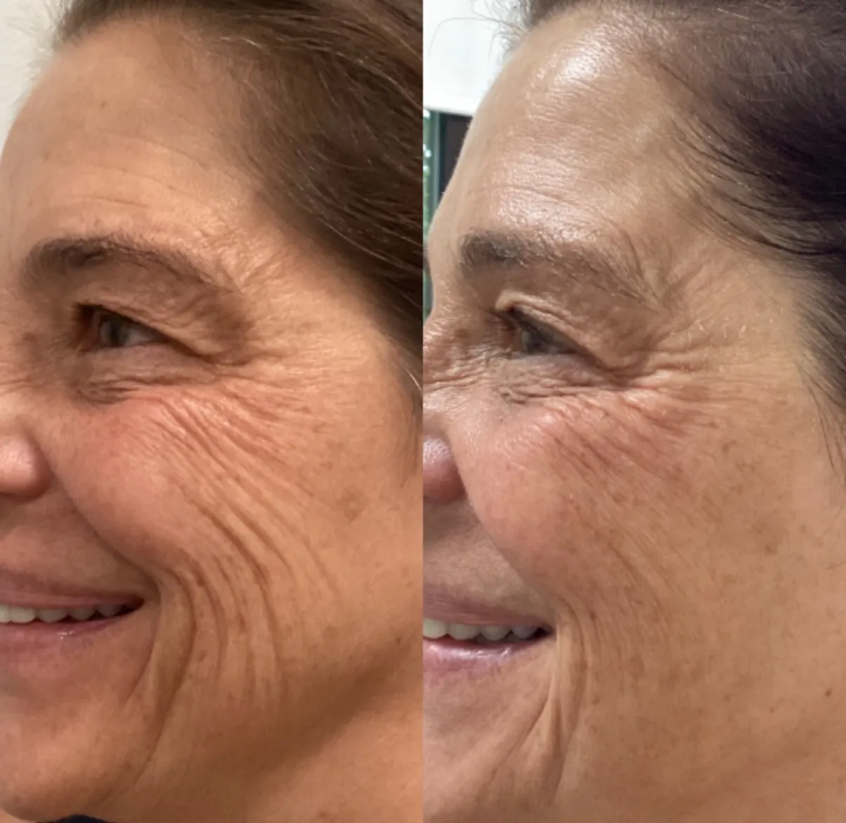 Laser treatment for wrinkles and skin texture, close-up of the eye area, before and after, at La Miel Aesthetics in Raleigh, NC