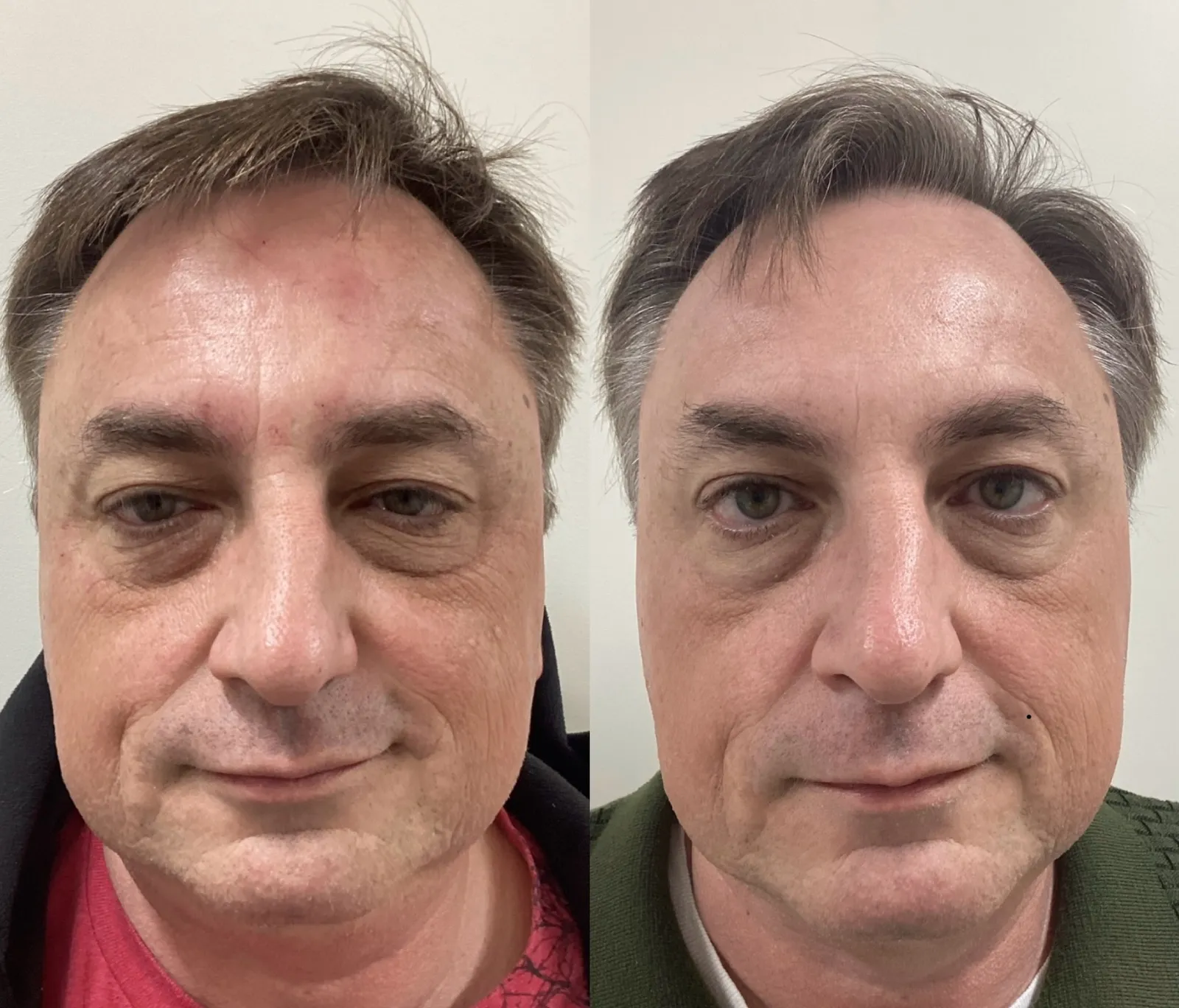 Refresh laser for wrinkles and skin texture, front view of the full face, before and after, at La Miel Aesthetics in Raleigh, NC