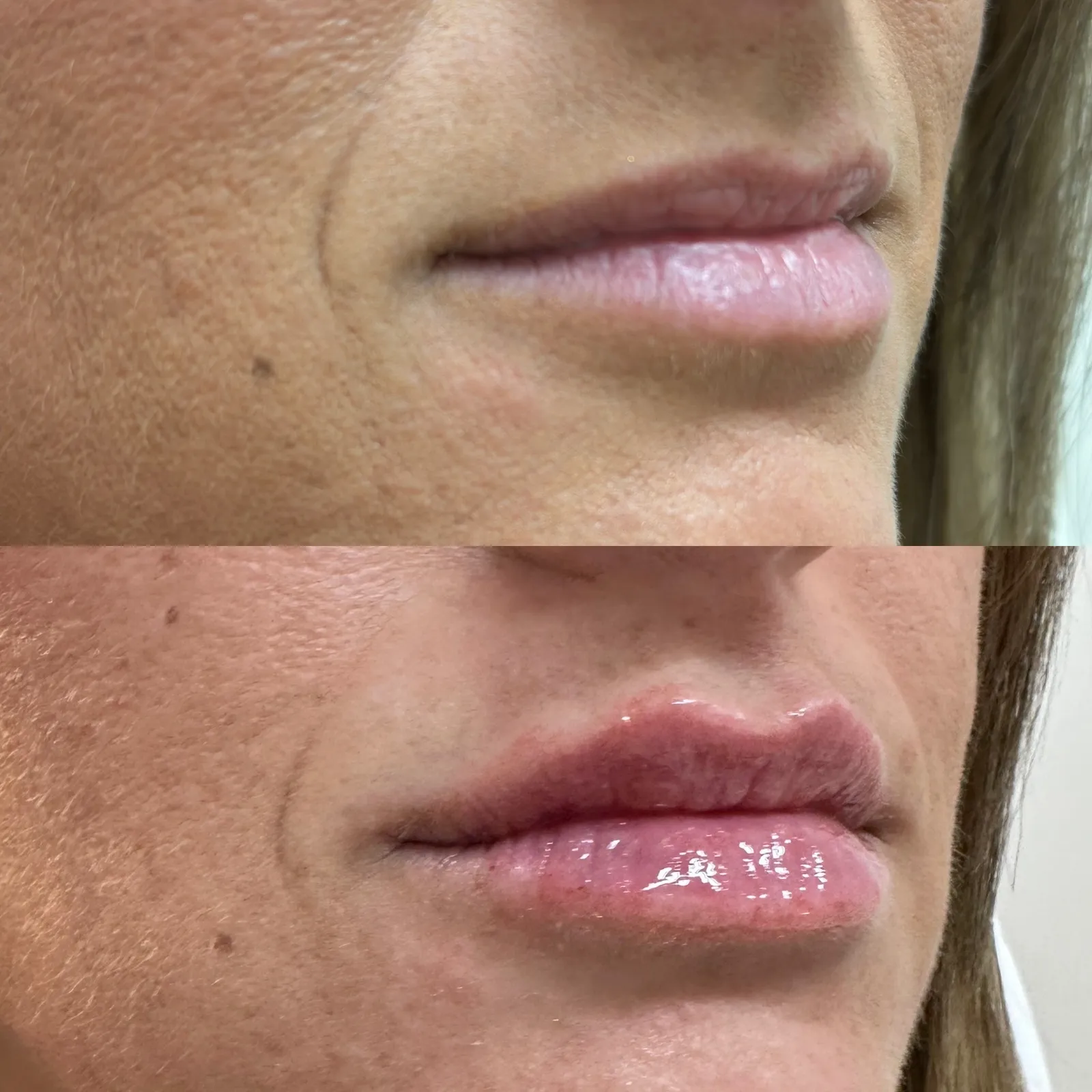 Lip filler, three-quarter view of the lips, before and after, at La Miel Aesthetics in Raleigh, NC