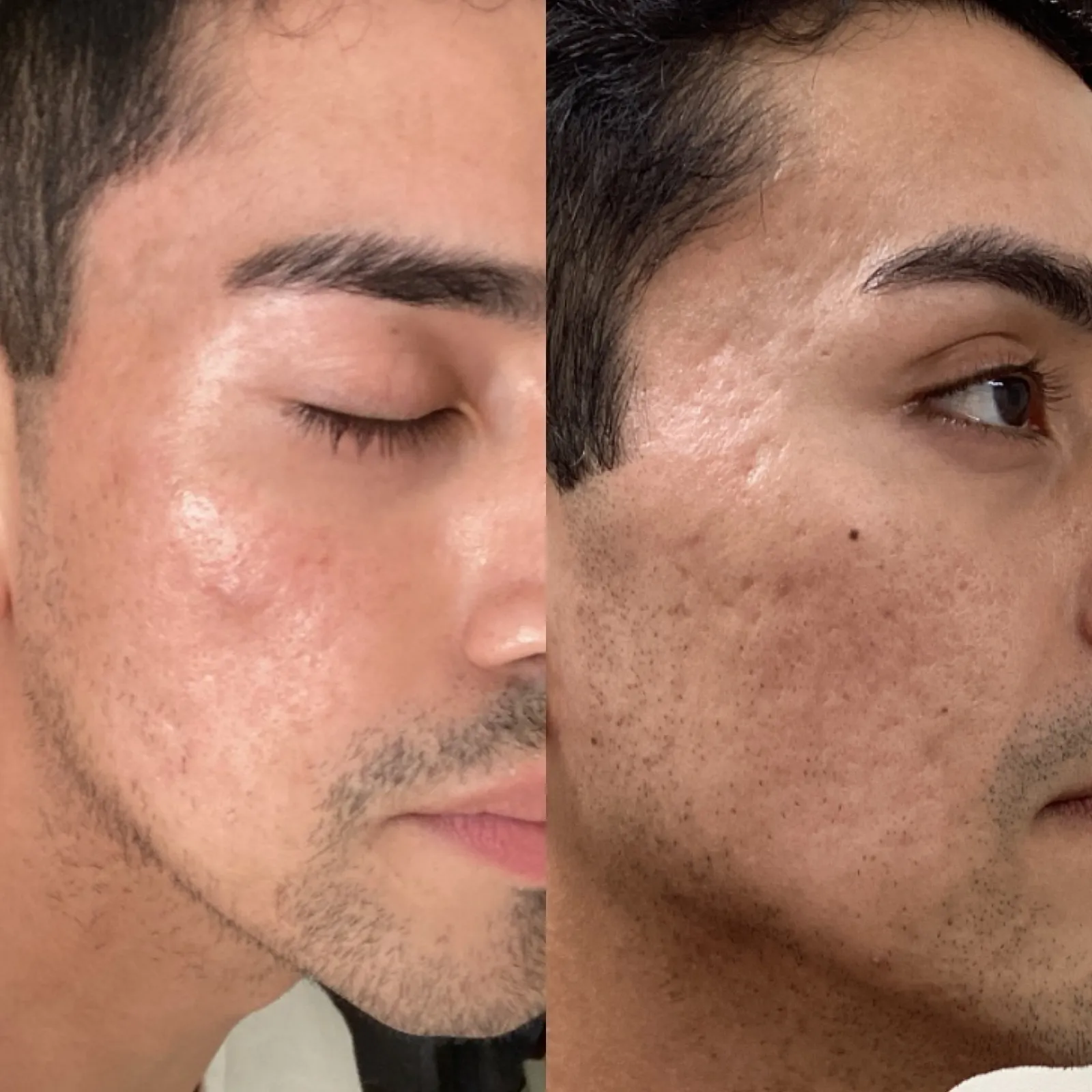 Microneedling for acne scars, three-quarter view of the cheeks, before and after, at La Miel Aesthetics in Raleigh, NC