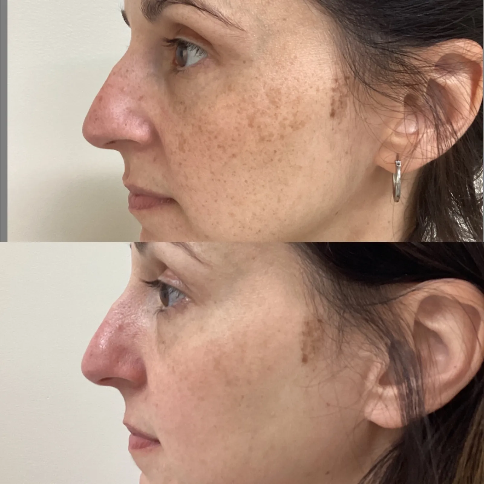 Microneedling for skin texture and tone, profile view of the cheeks, before and after, at La Miel Aesthetics in Raleigh, NC