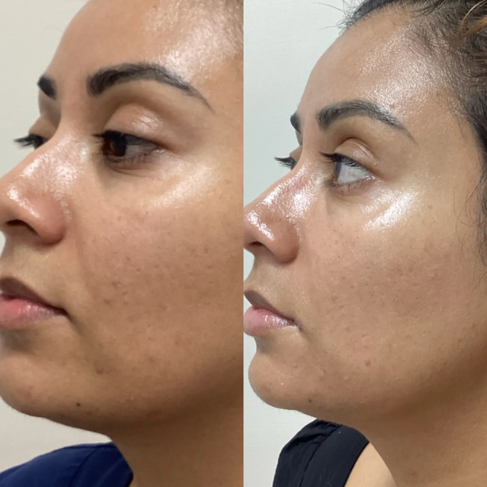 Microneedling for skin texture and tone, three-quarter view of the cheeks, before and after, at La Miel Aesthetics in Raleigh, NC